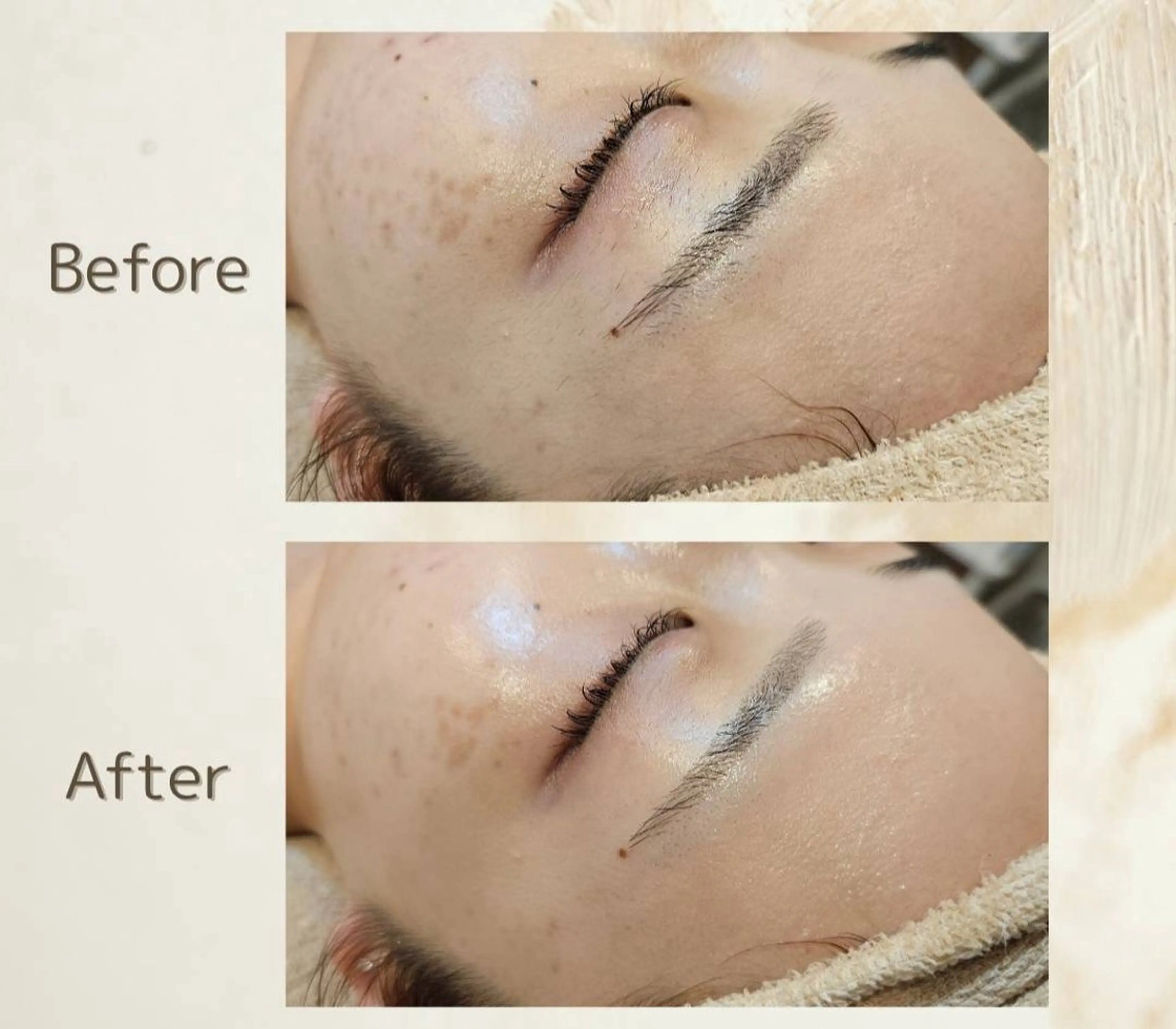 【学割 U24】ニキビ予防ケアシェービングの写真