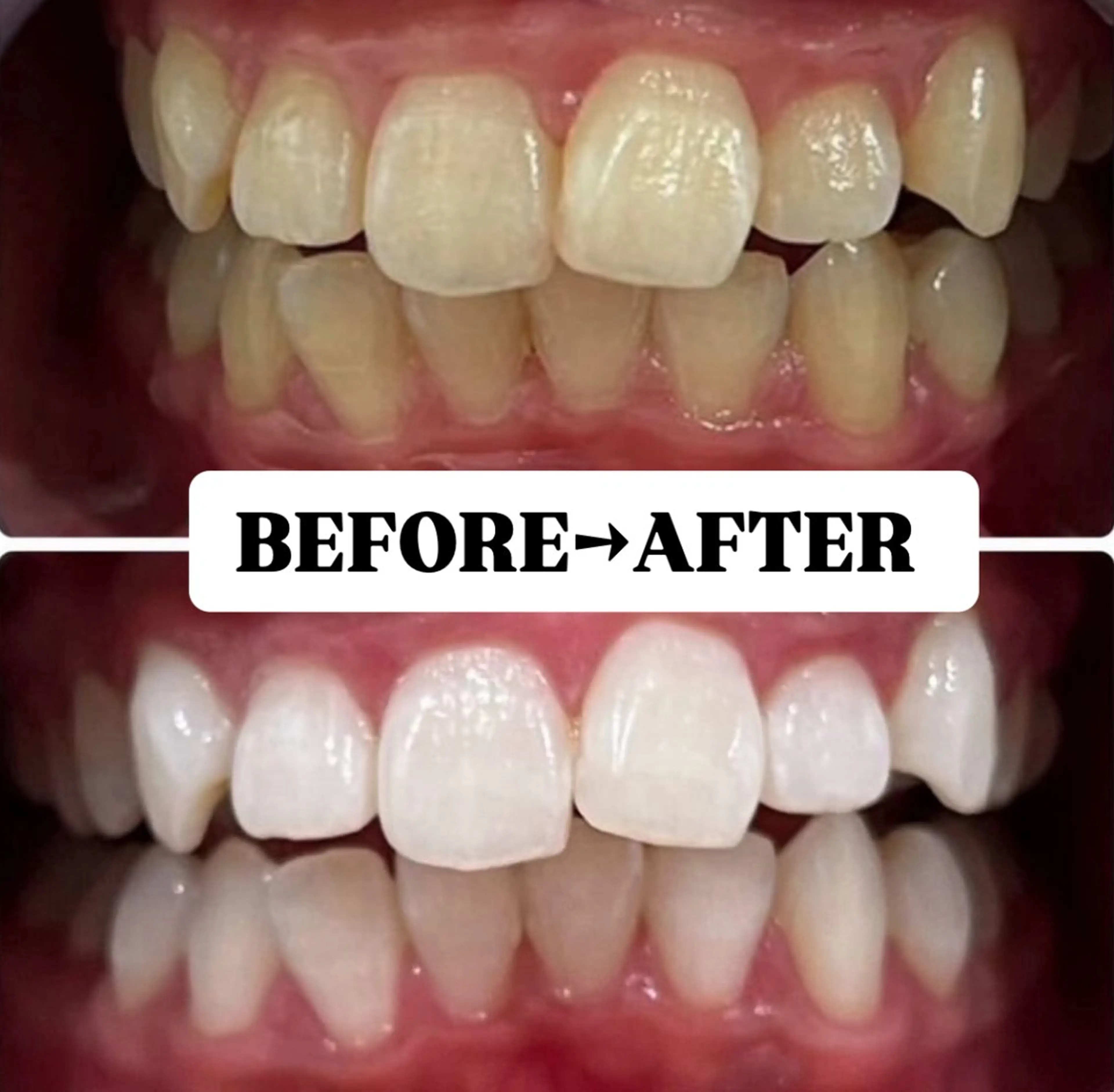 【minimo特別セール価格★】お試し♪速攻効果実感！美白ホワイトニング20分×2回照射¥1,500の写真