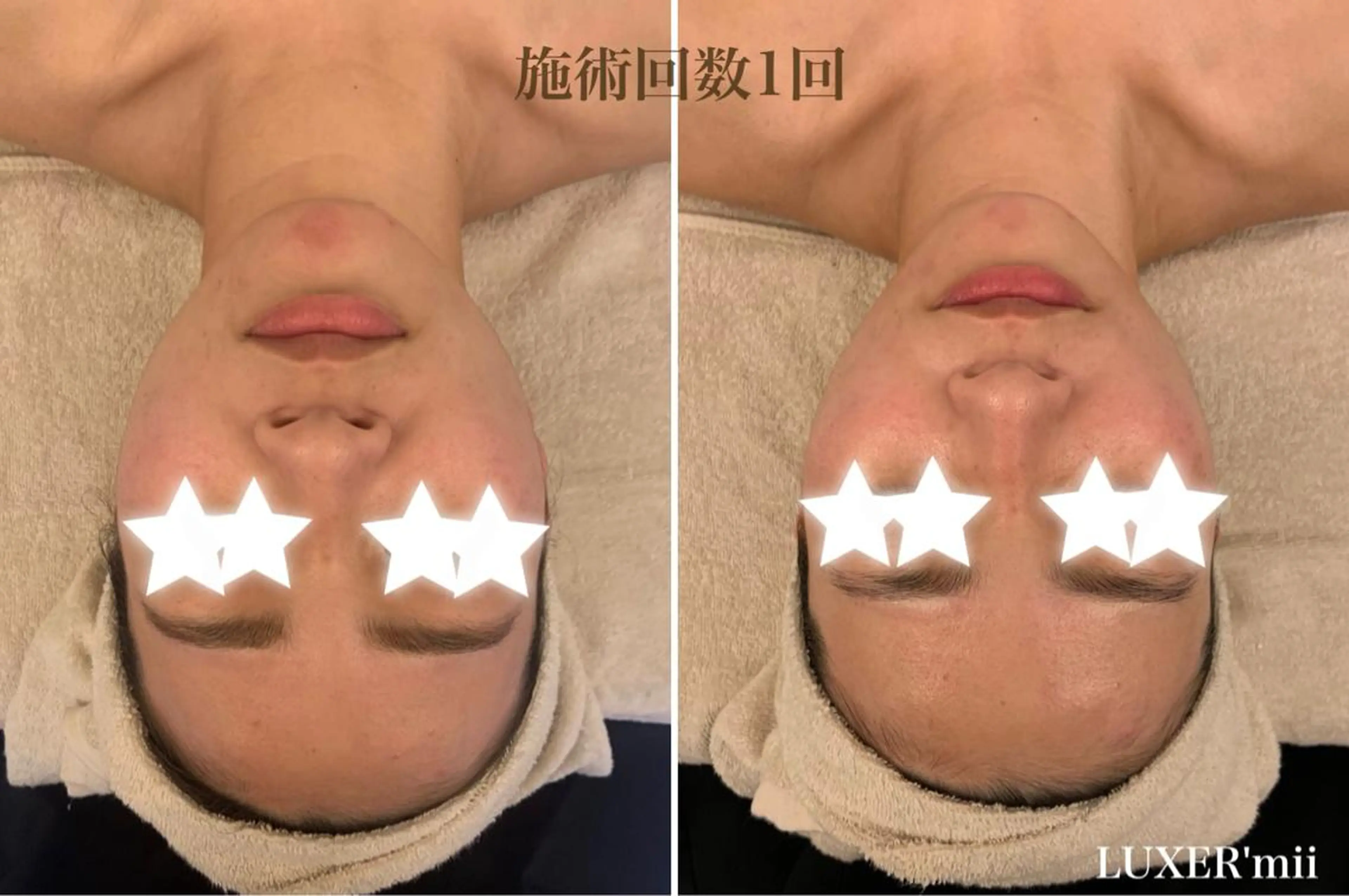 即効性抜群！WINBACK＋小顔コルギ（デコルテ付）65分の写真