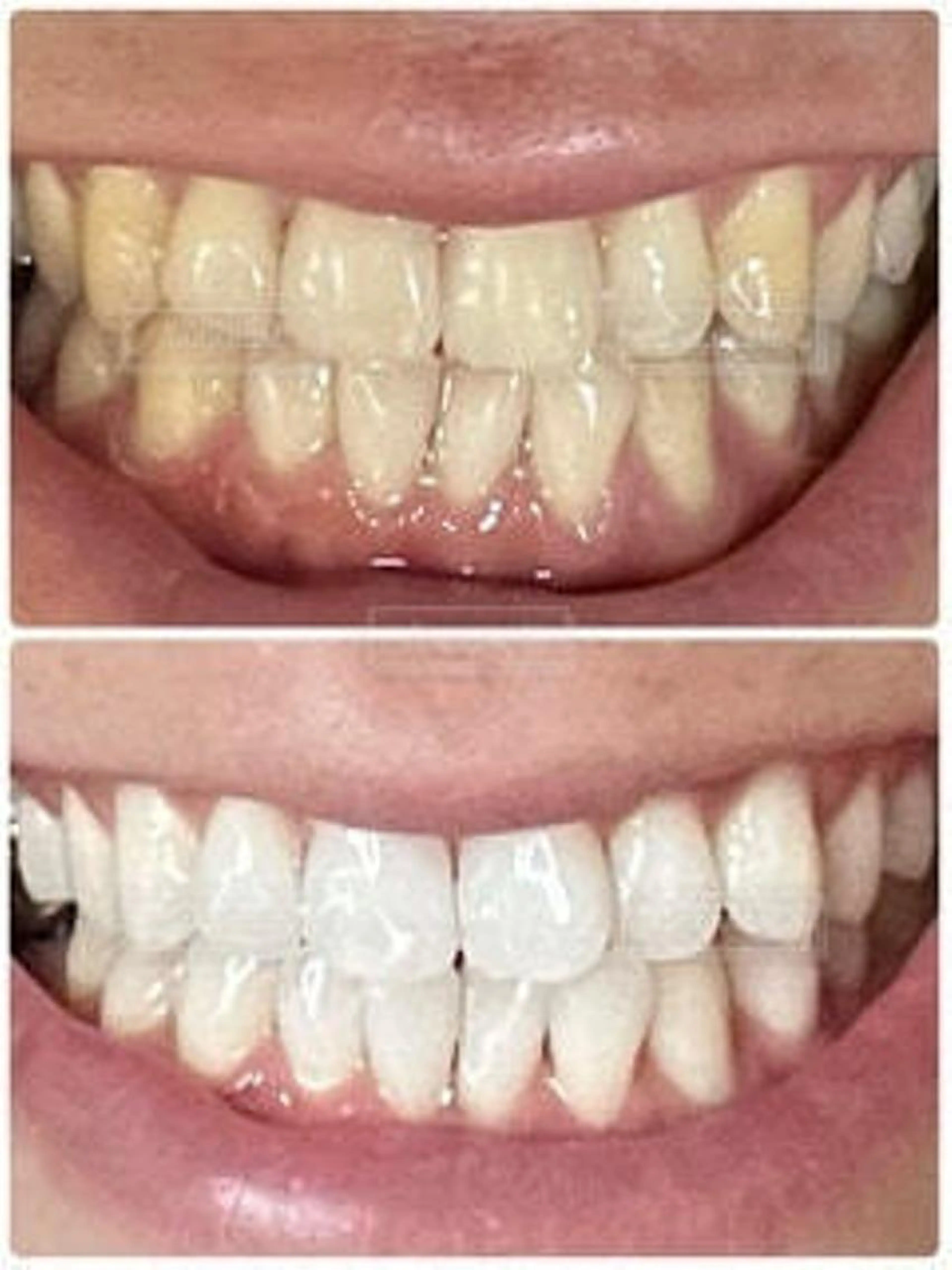 【効果を実感✨30分】セルフホワイトニング15分✕2回《¥4,000》の写真