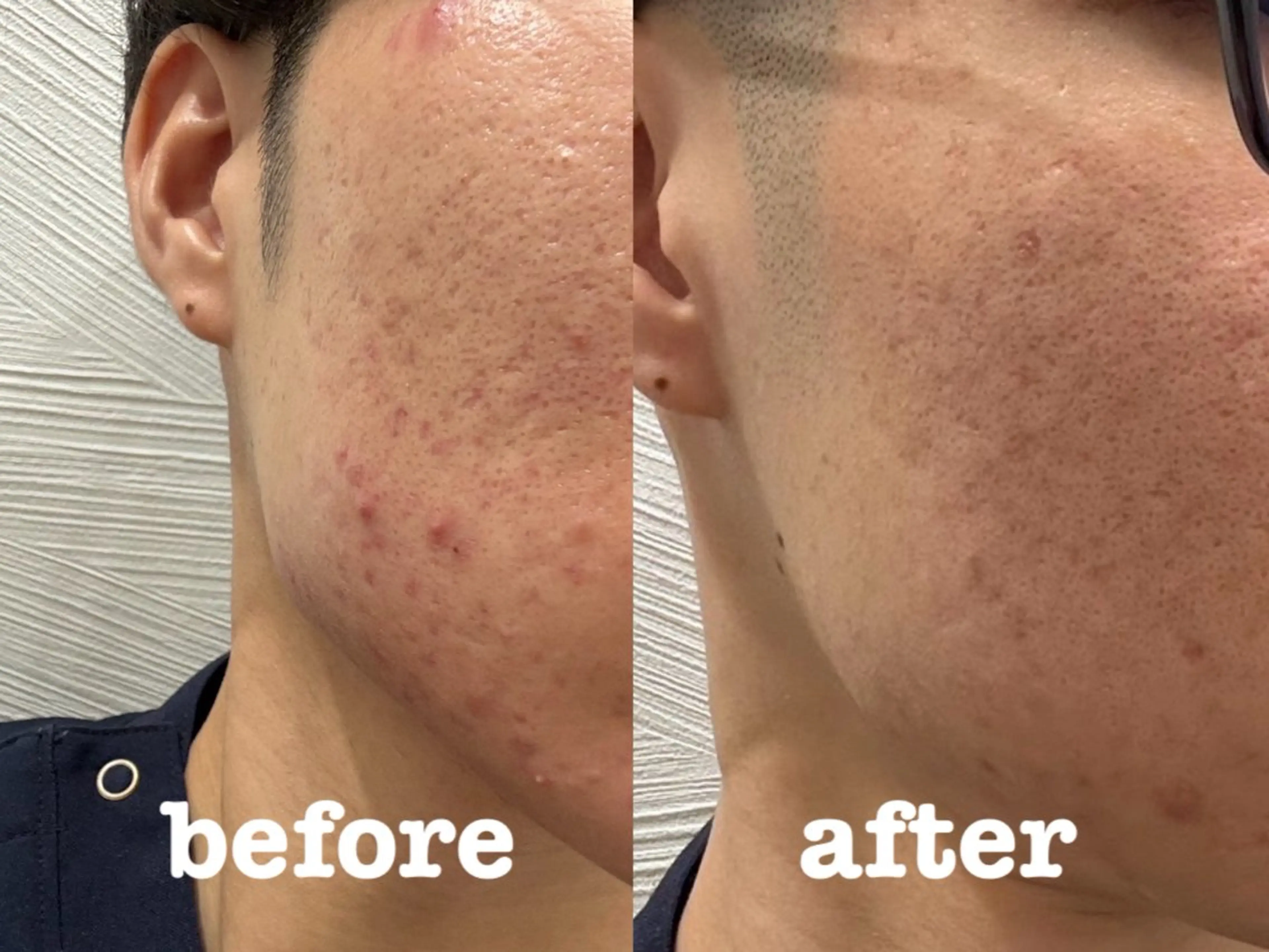 エステ リラク 肌質改善×美容鍼 ゆいのエステ・リラクイメージ