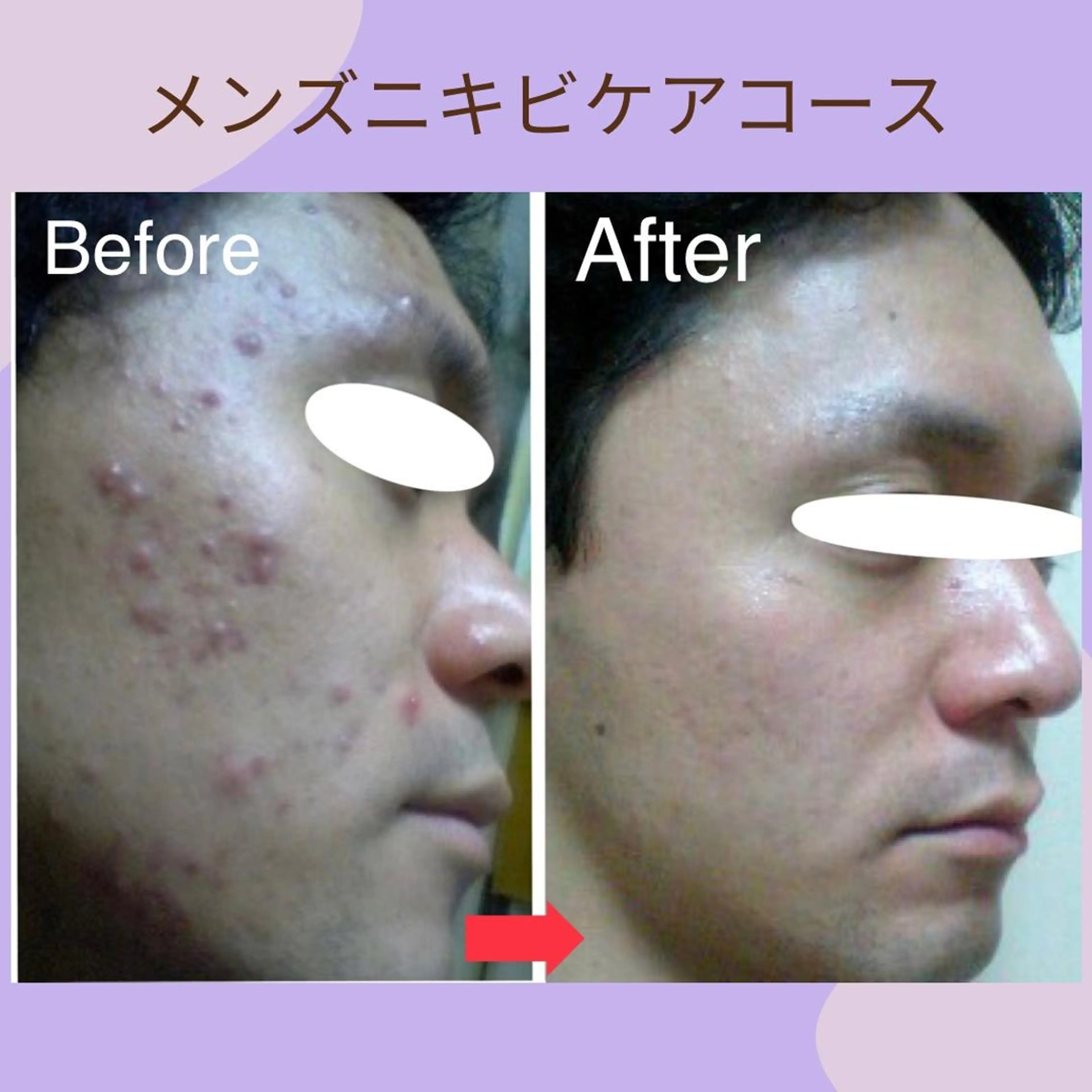 【メンズ限定メニュー】男の皮膚トラブル・乾燥・過剰皮脂など。お悩み別ケアフェイシャルの写真