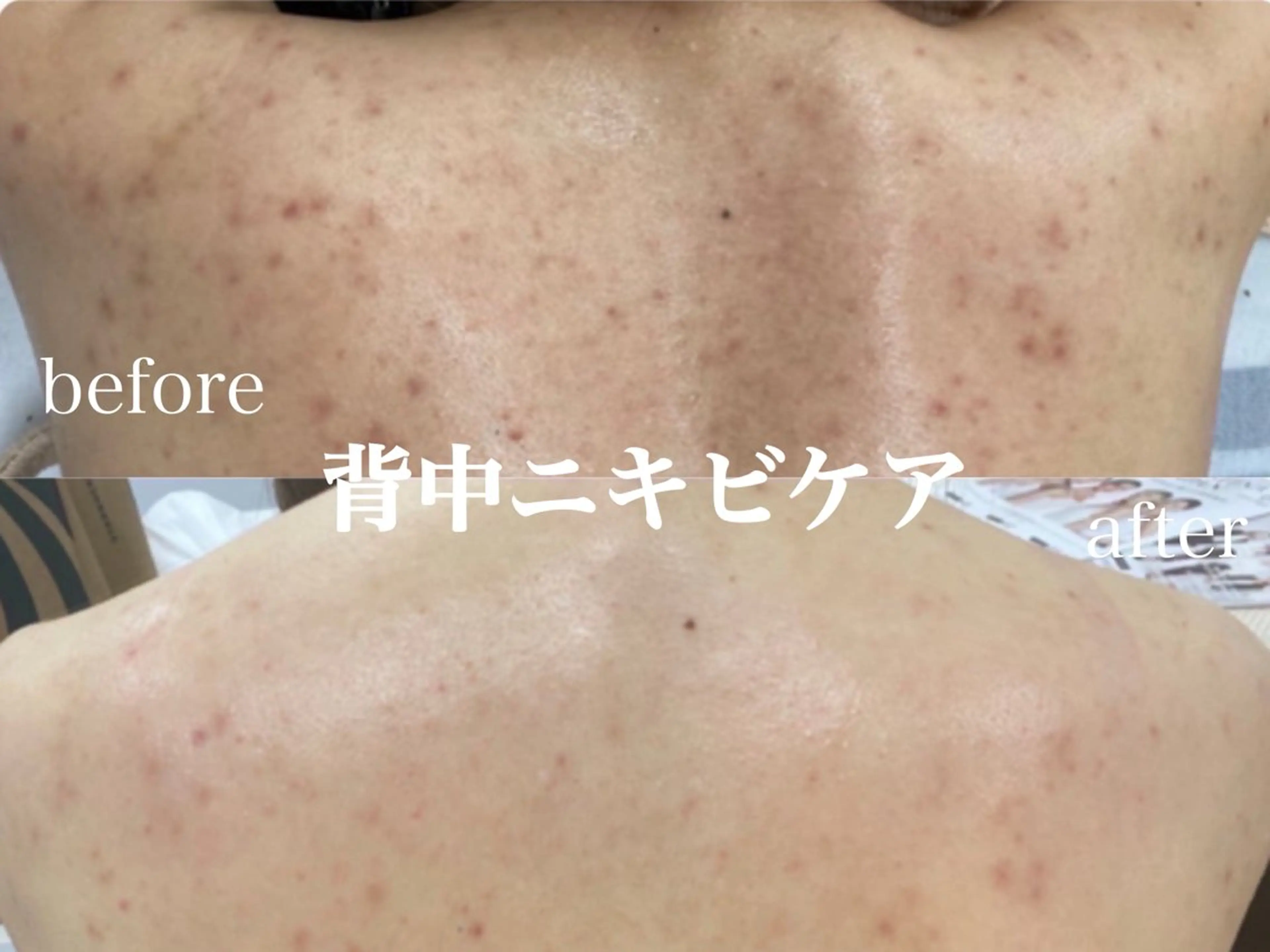 夏に向けて☀️背中　二の腕　お尻選べるハーブピーリング🌿22,000→8980の写真