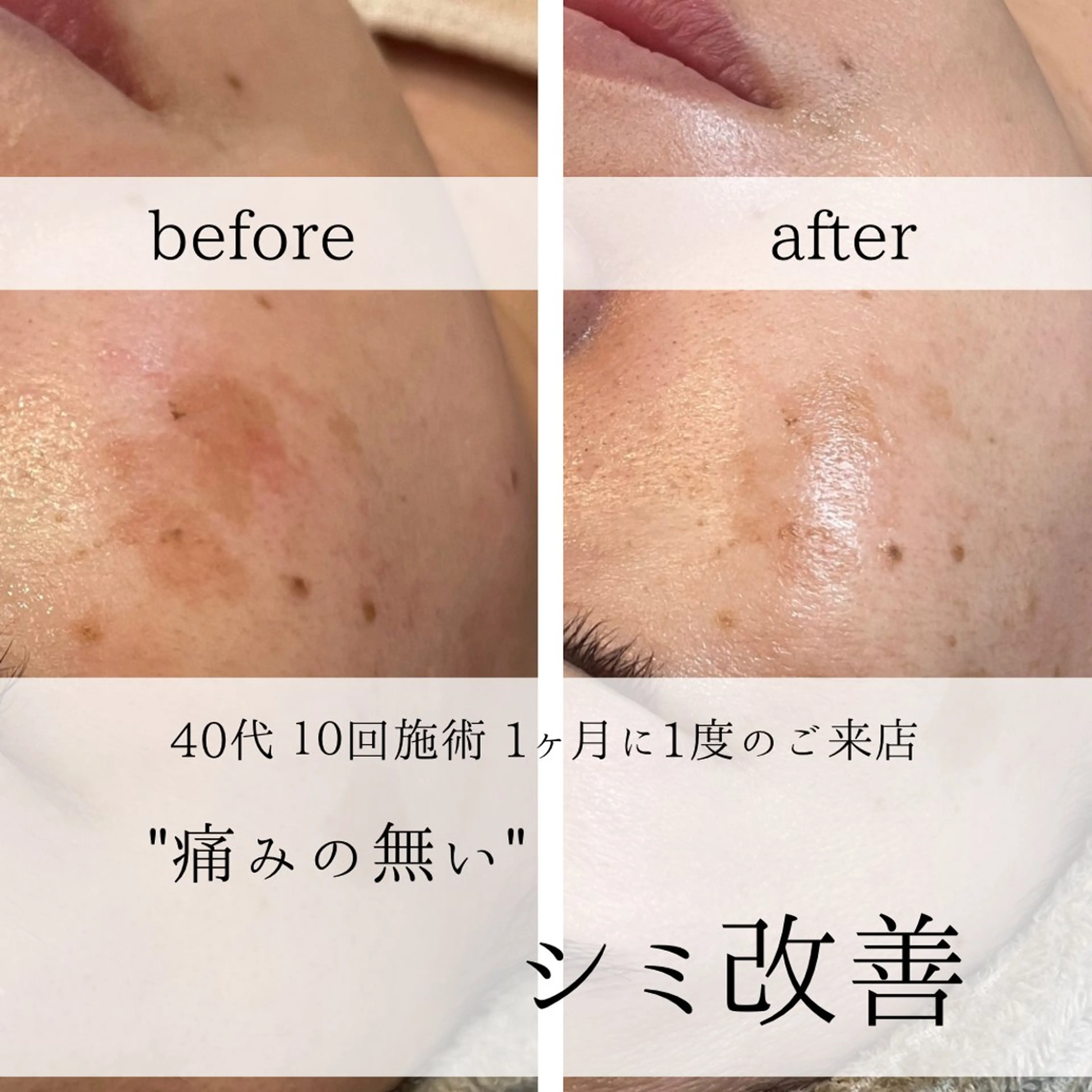 yc.hacci 【ハーブピーリング】の眉毛・アイブロウイメージ