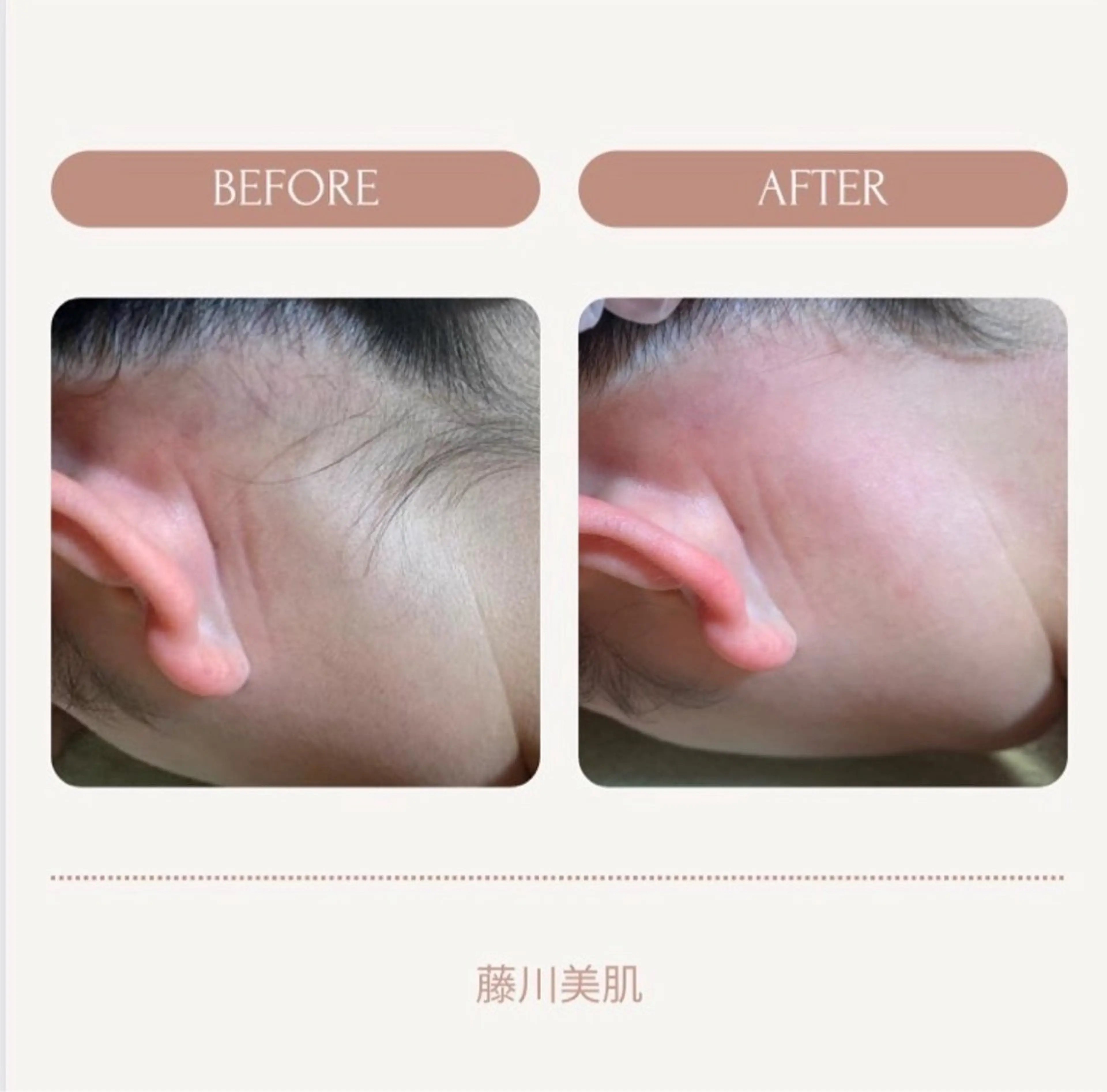 脱毛 藤川美肌製造所所属・藤川 明花のエステ・リラクイメージ