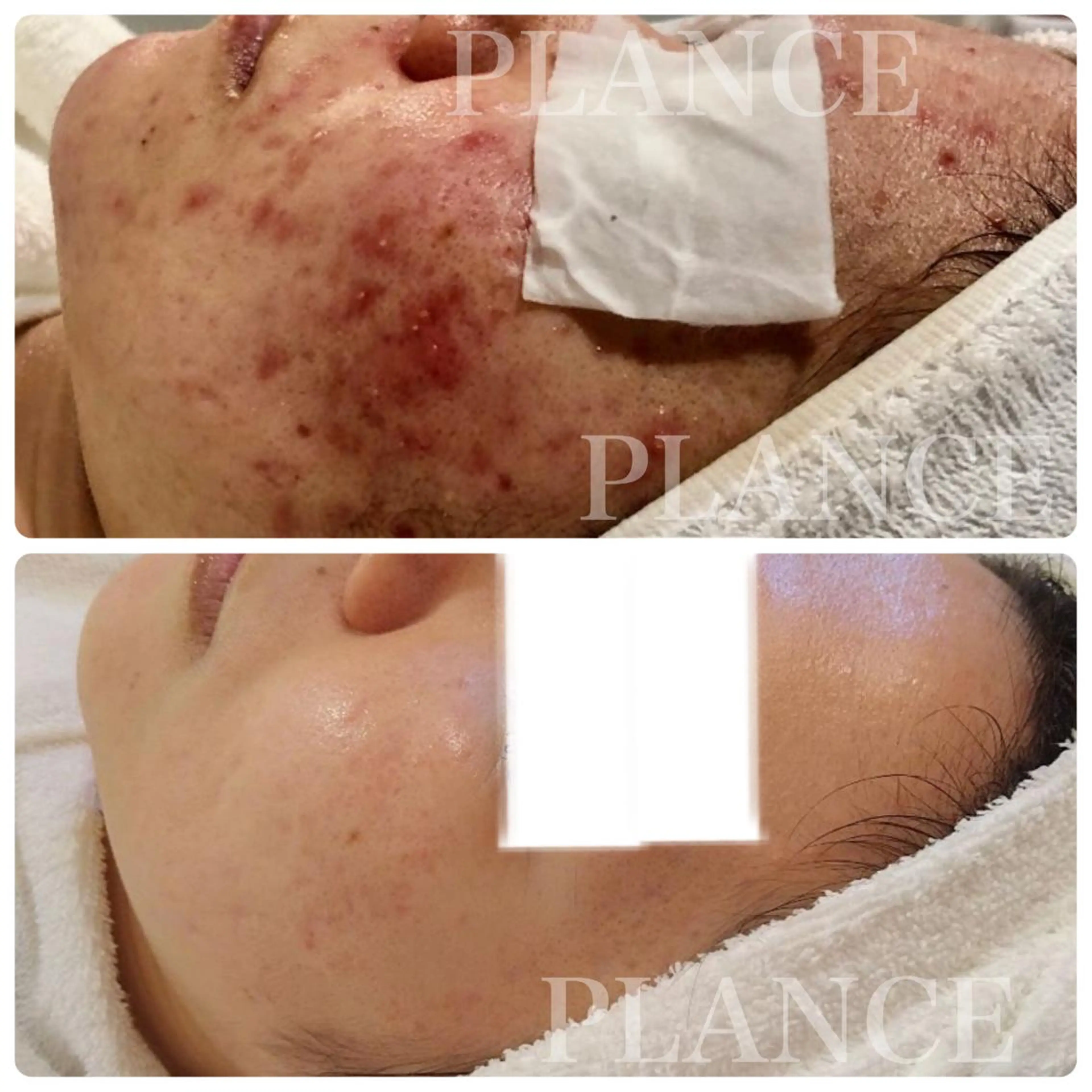 エステ フェイシャル専門 肌質改善/プランスのエステ・リラクイメージ