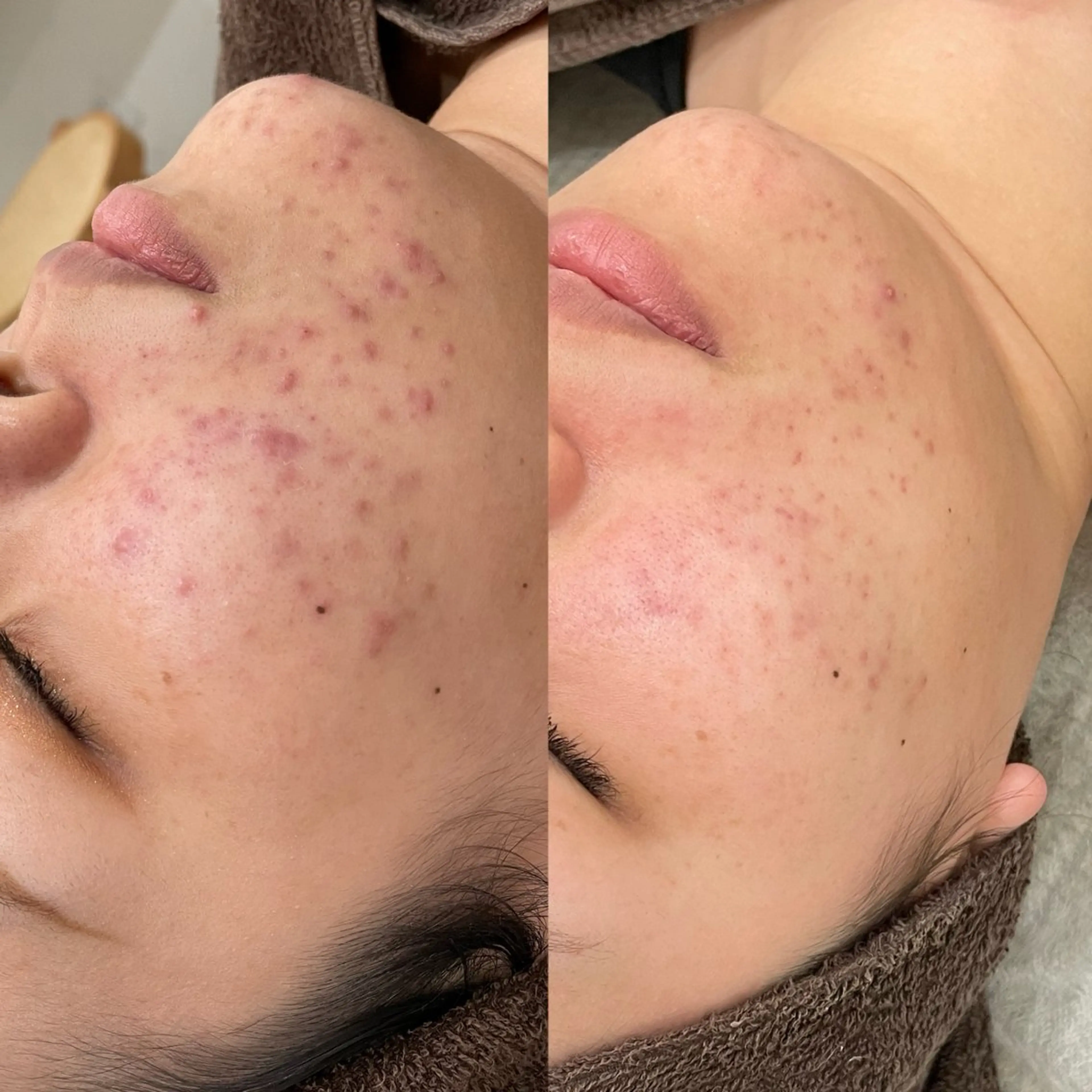 【平日限定】ハーブピーリング剥離あり🌿🥣の写真