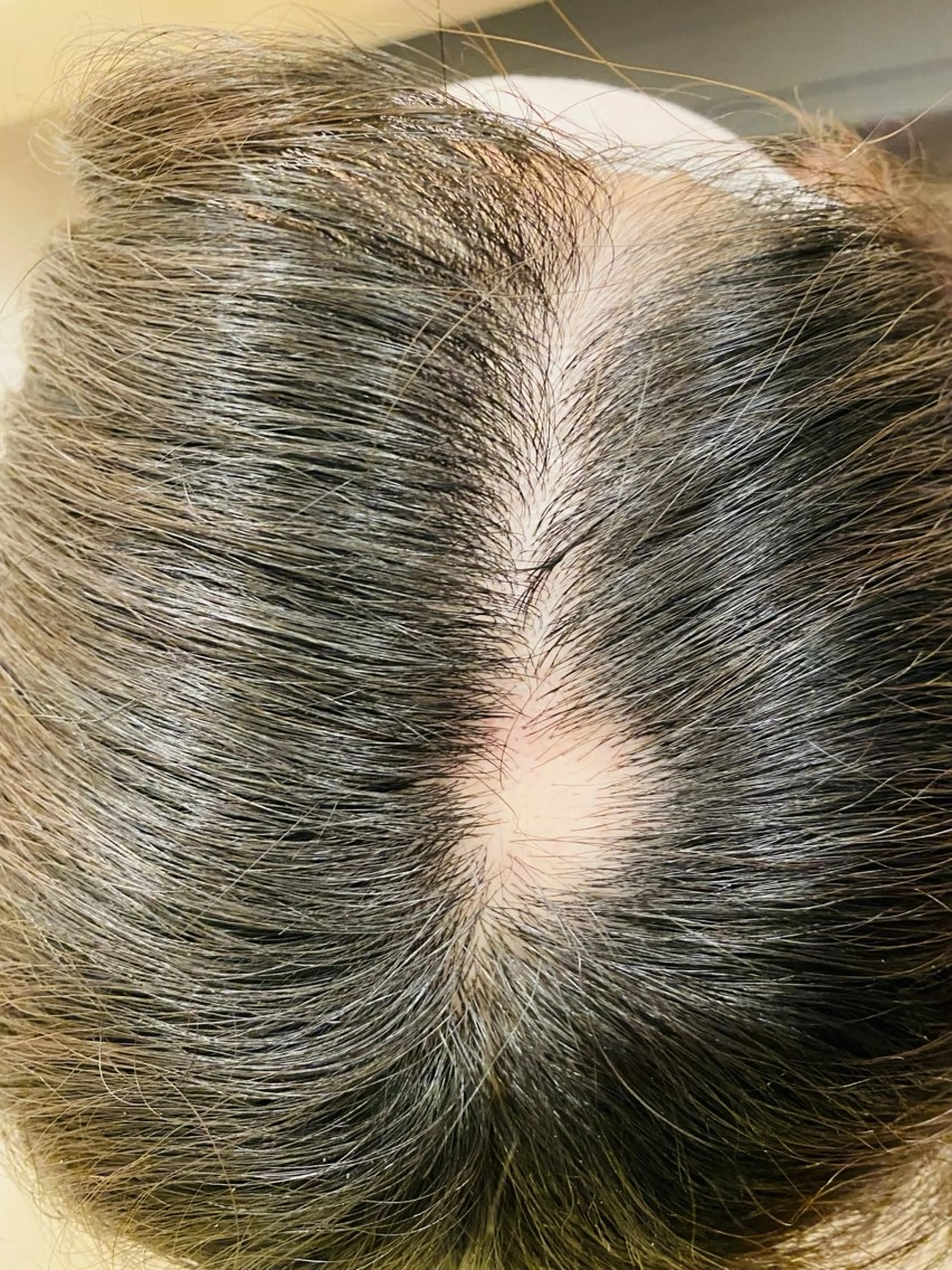 【育毛鍼】薄毛／円形脱毛症の施術モニター募集（92%OFF）の写真