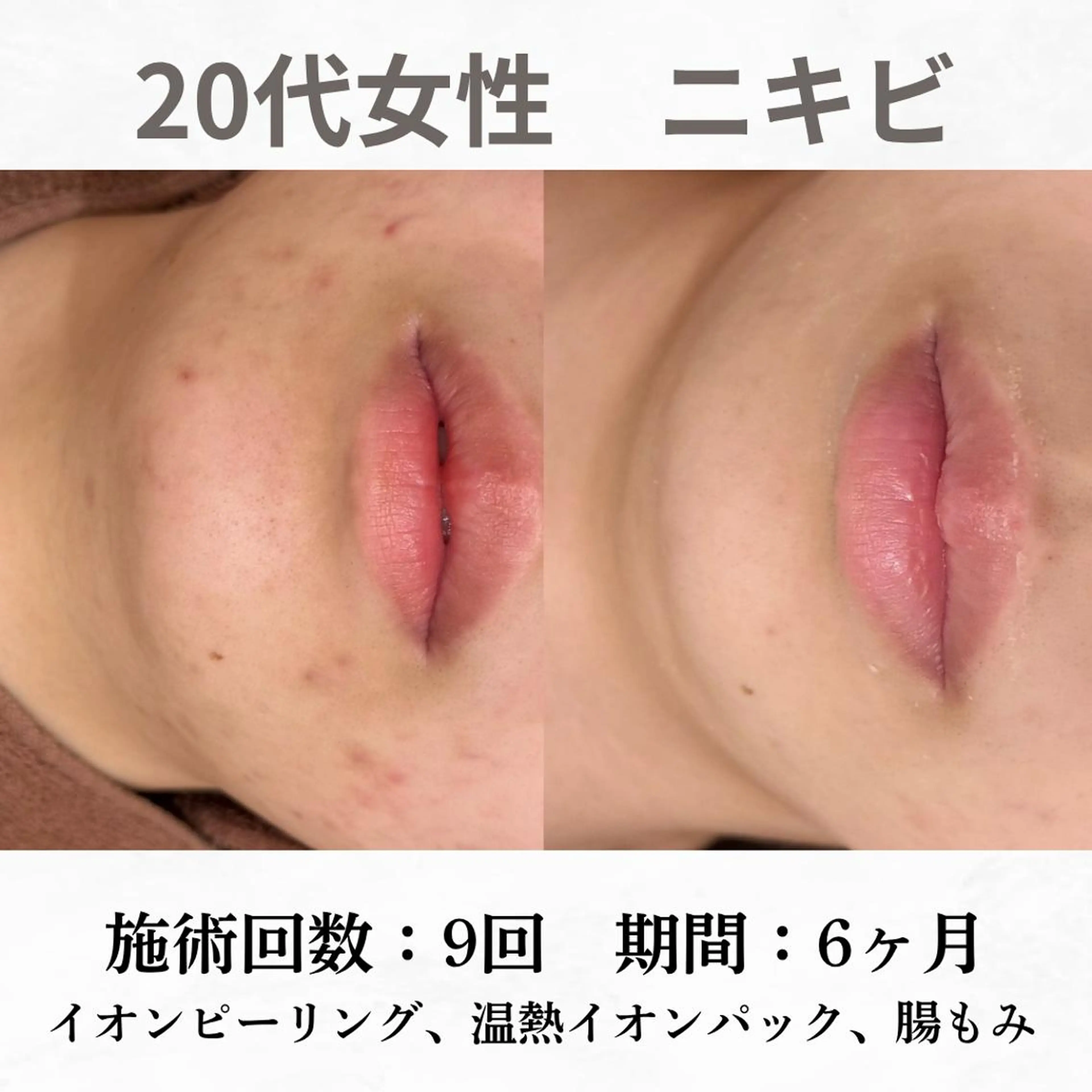重度ニキビ専門🌷 ダウンタイムなしのエステ・リラクイメージ