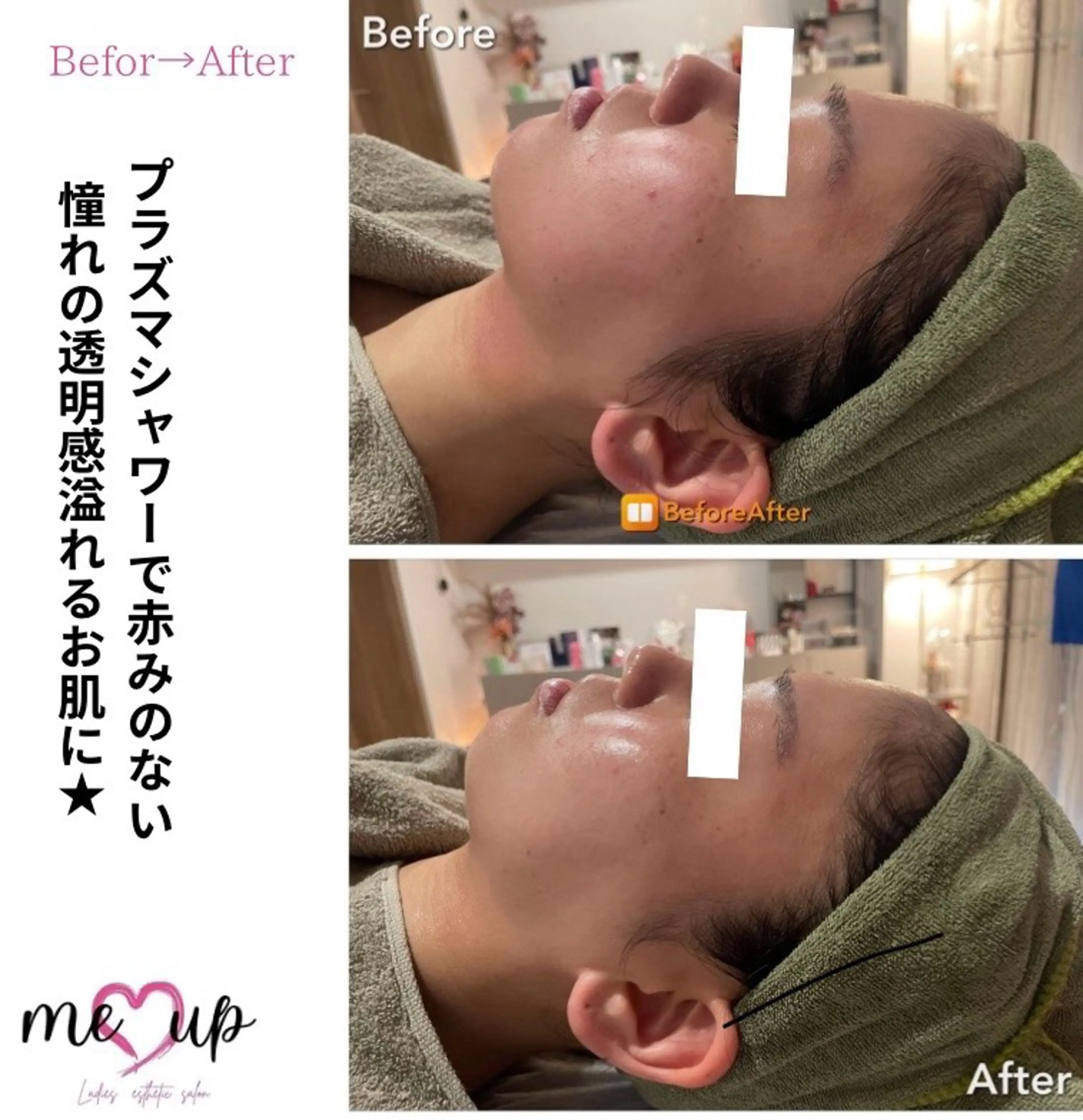 エステ Meupニキビ専門店 背中/ハーブ/肌管理のその他イメージ