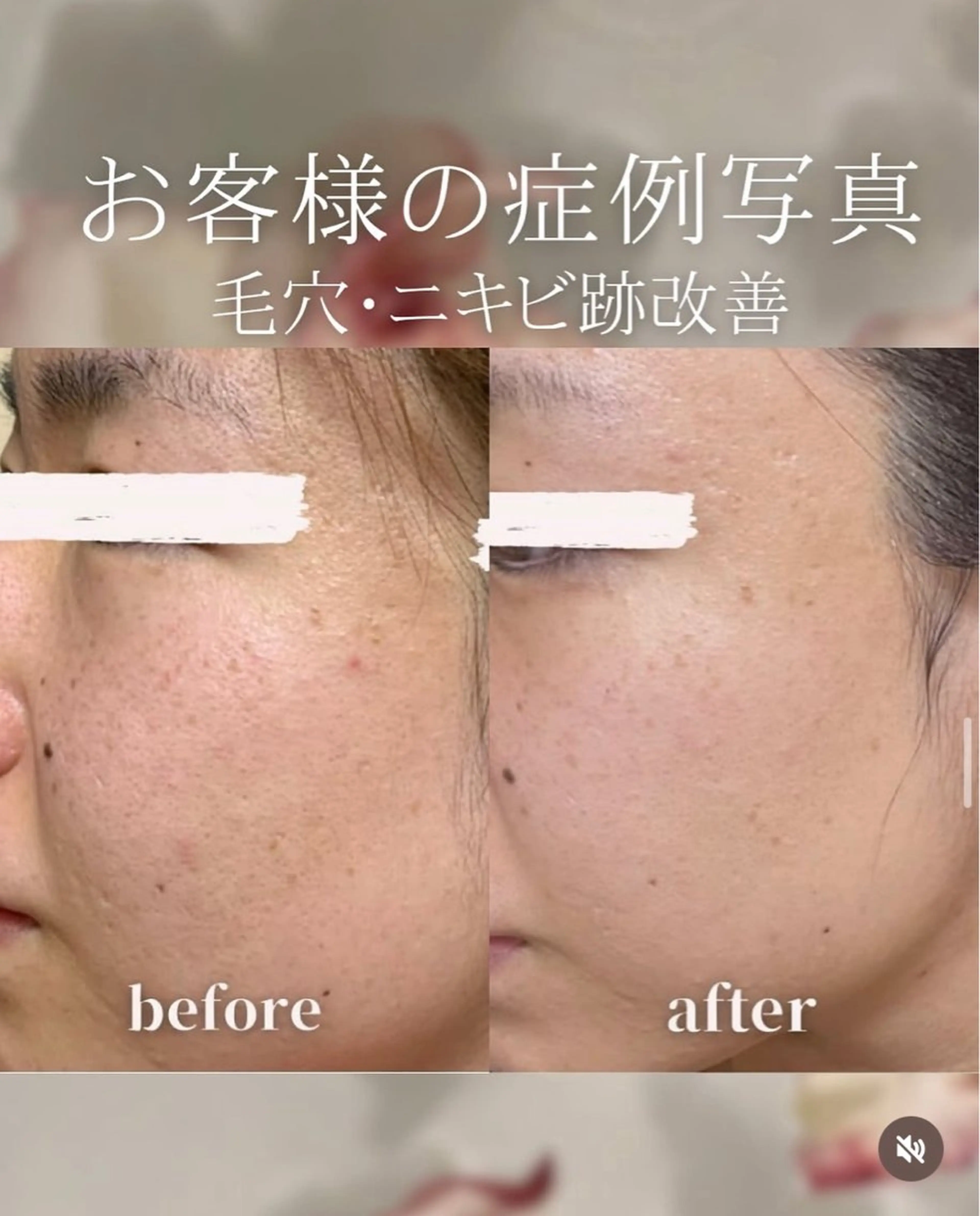 【冬の乾燥・くすみ対策】フェイシャル＋高品質！美白スペシャルケアコース🪽シミ・くすみ改善◎の写真