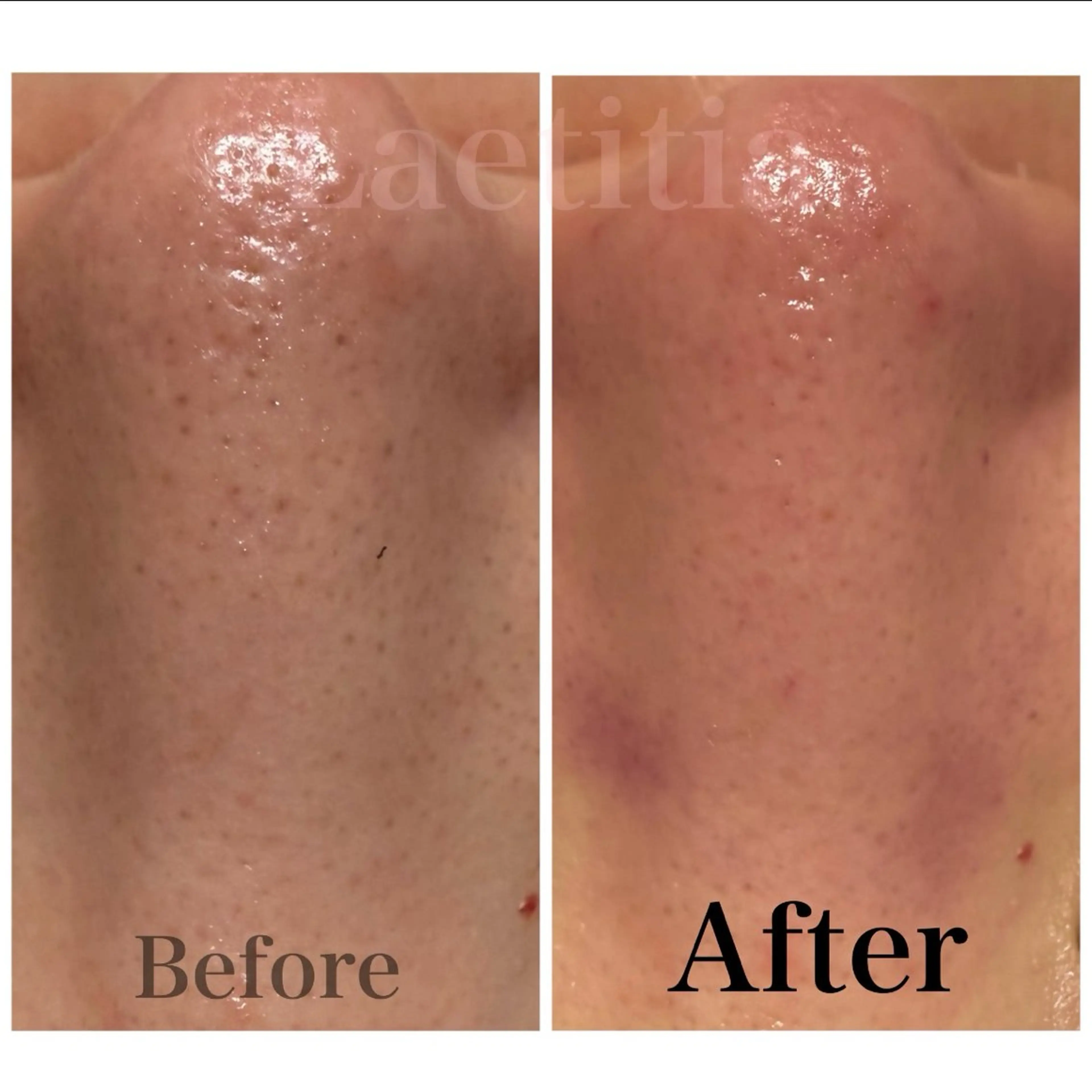 【気になる鼻周りの角質・角栓をごっそり解消✨】『鼻周り3D毛穴吸引+最新ハイドロジェリーマスク(鼻)』の写真