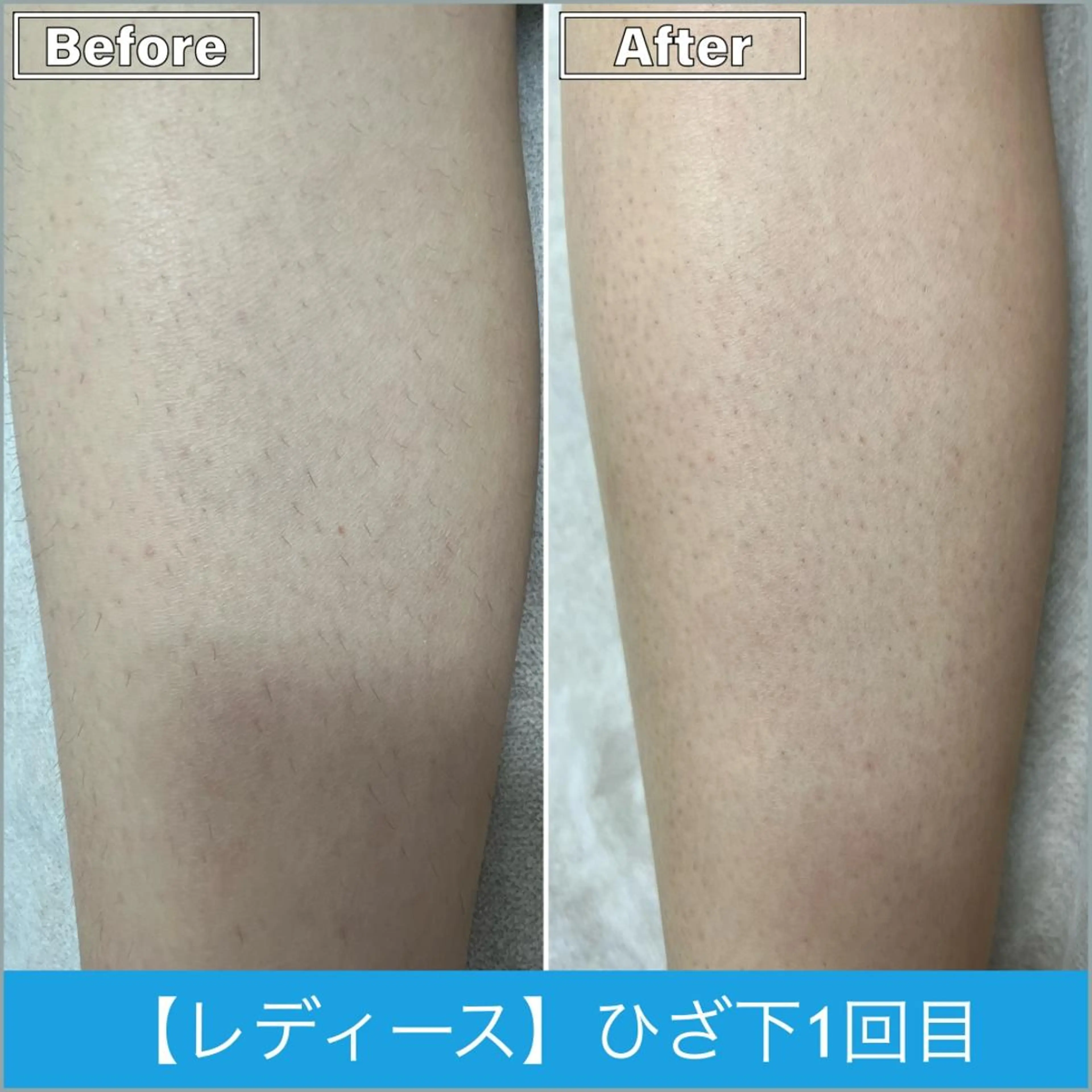 脱毛 プライベートサロン シャルムのその他イメージ