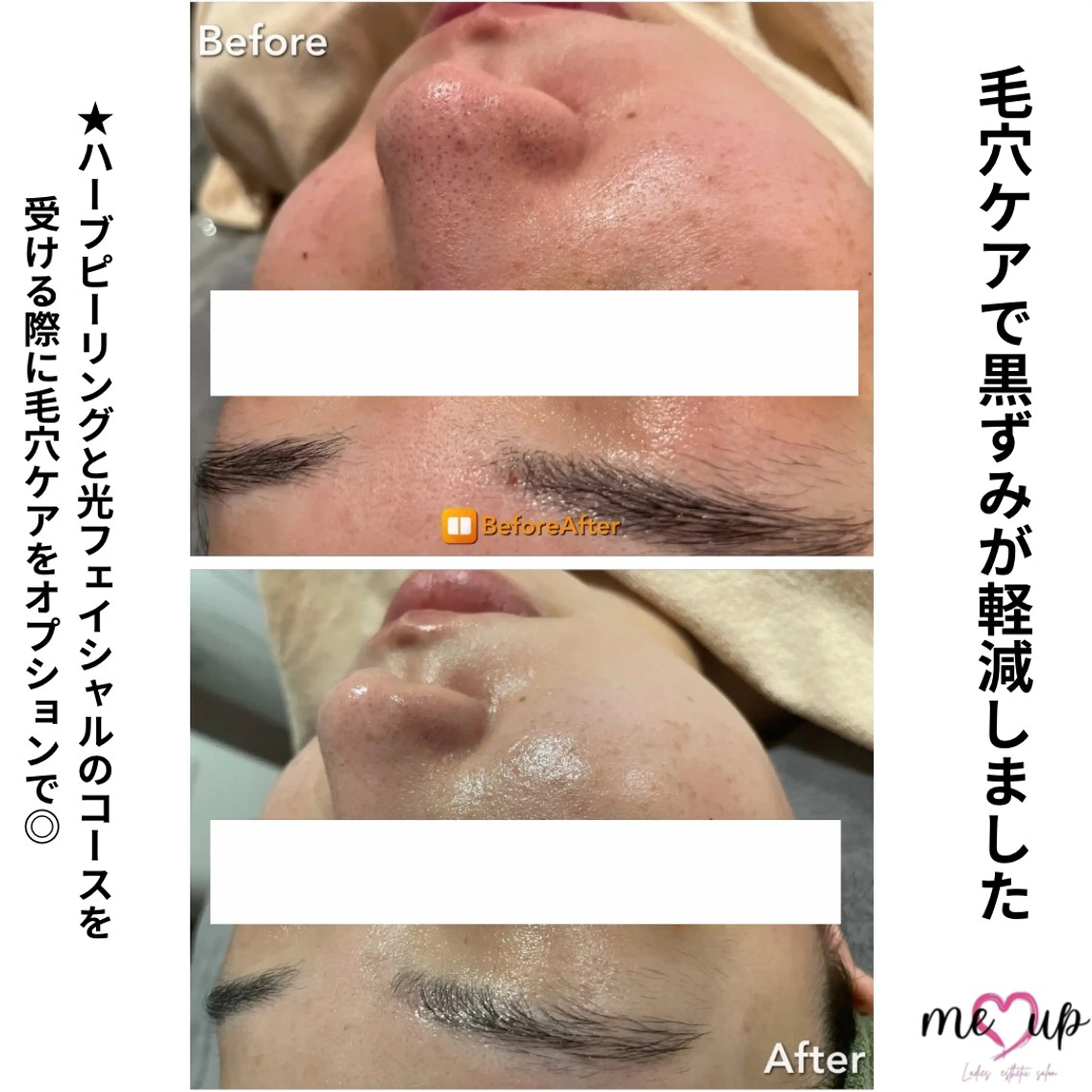 エステ Meupニキビ専門店 背中/ハーブ/肌管理のその他イメージ