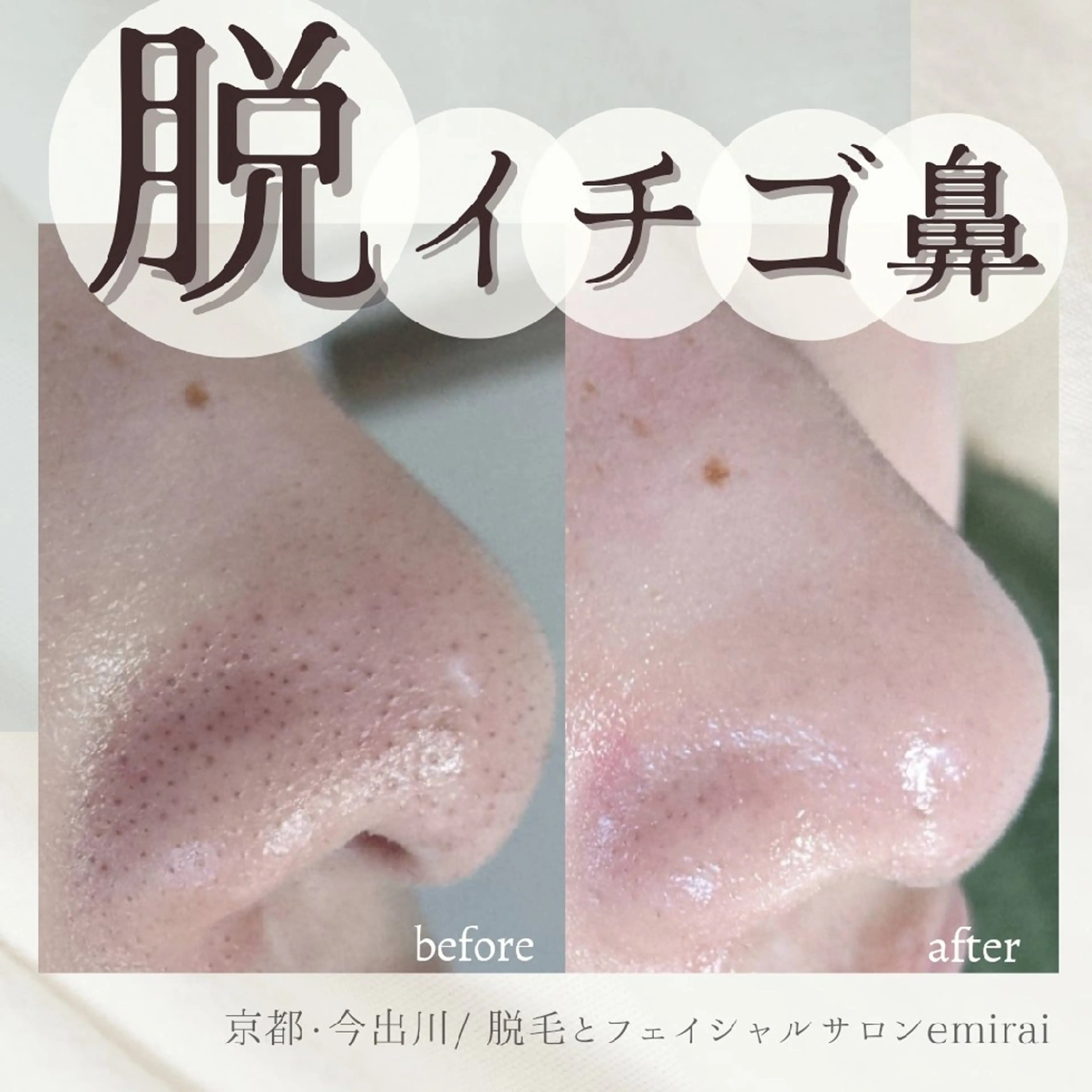 『毛穴の黒ずみにお悩みの方へ😔🍓』クリニック導入アリの機械で毛穴洗浄+美容液導入✨毛穴ケアハイドロスキンの写真