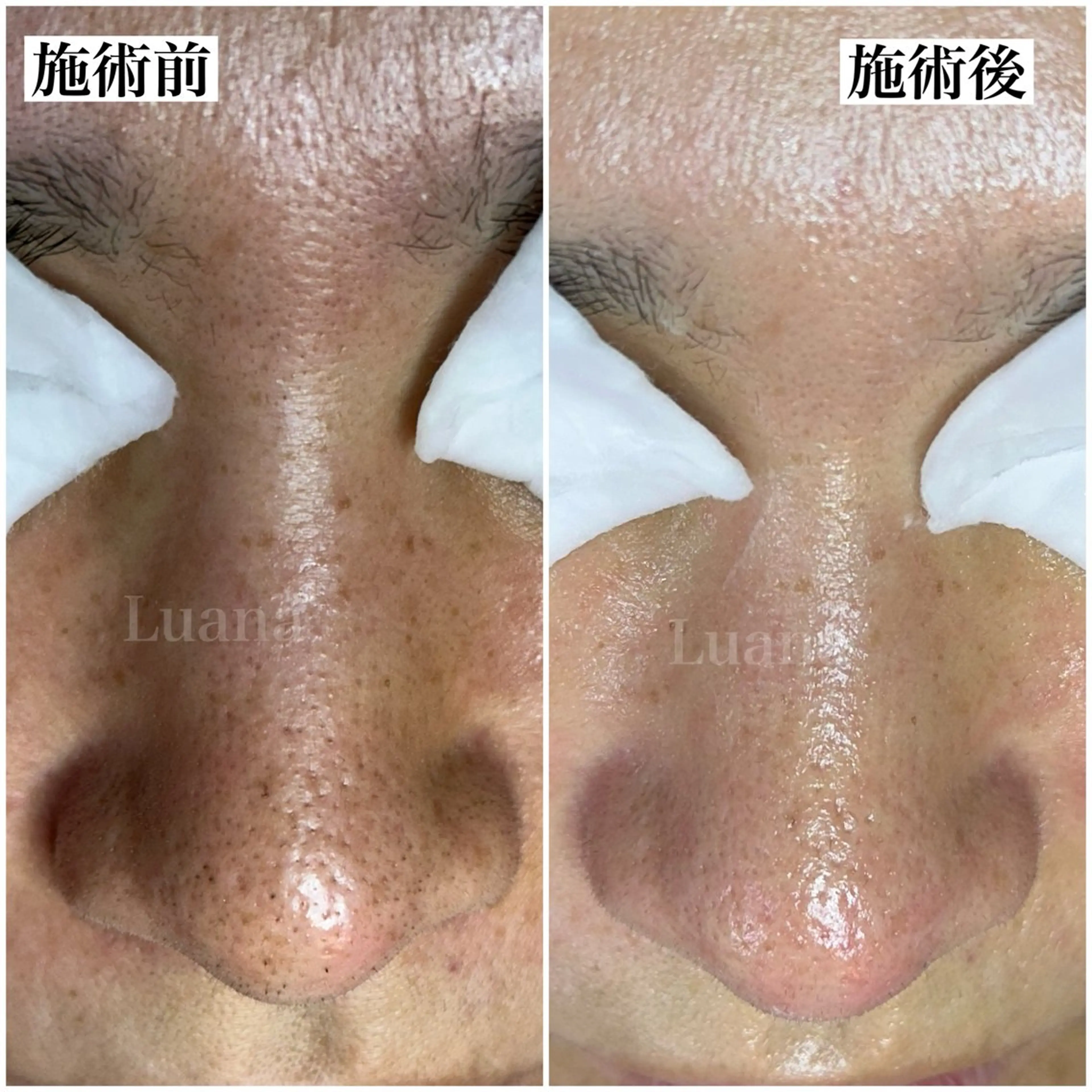 【毛穴洗浄】黒ずみ・詰まり・開き毛穴改善の写真