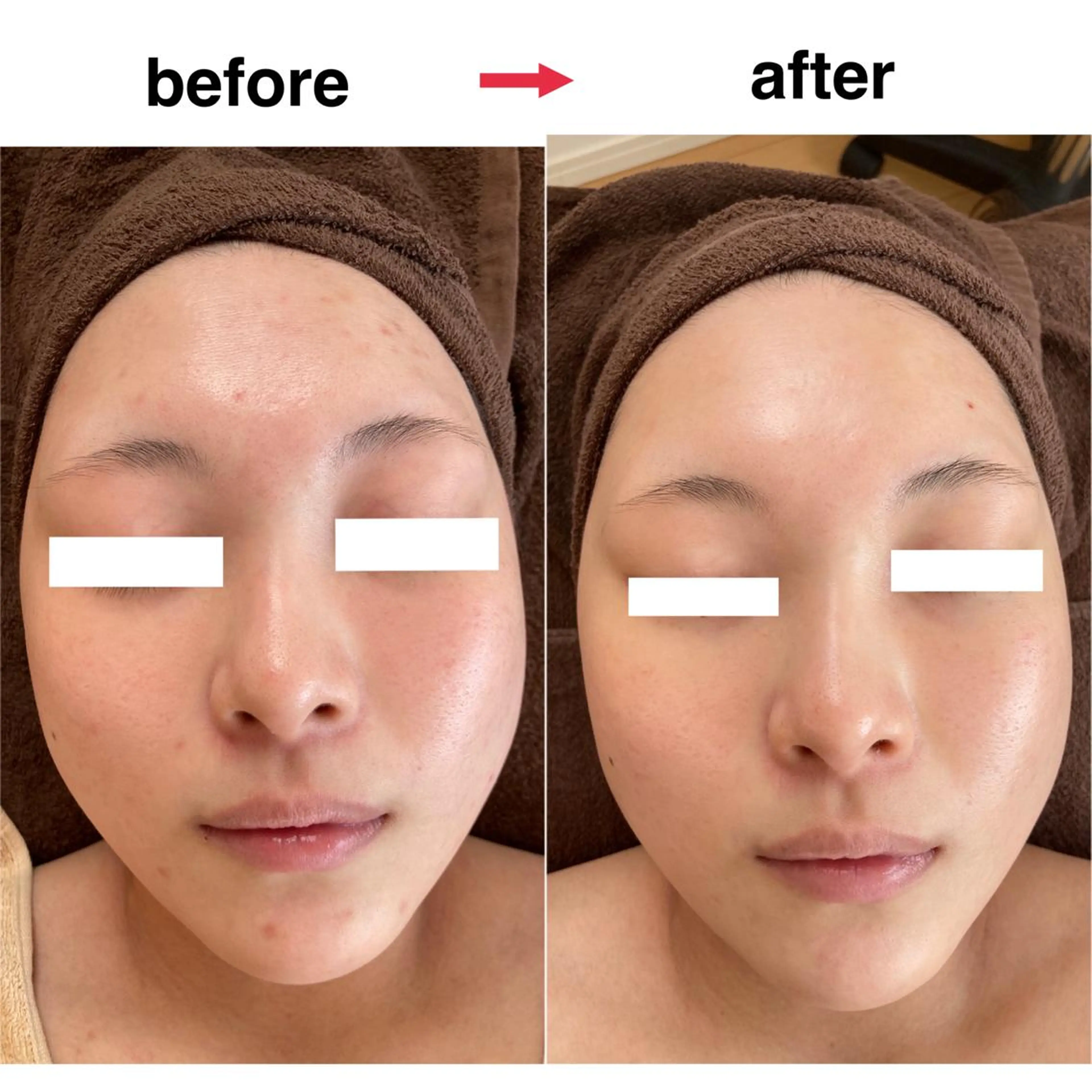 人気No.2✨ハーブピーリング🌿80分//ビタミンCまたはヒアルロン酸導入付き/デコルテマッサージ付きの写真