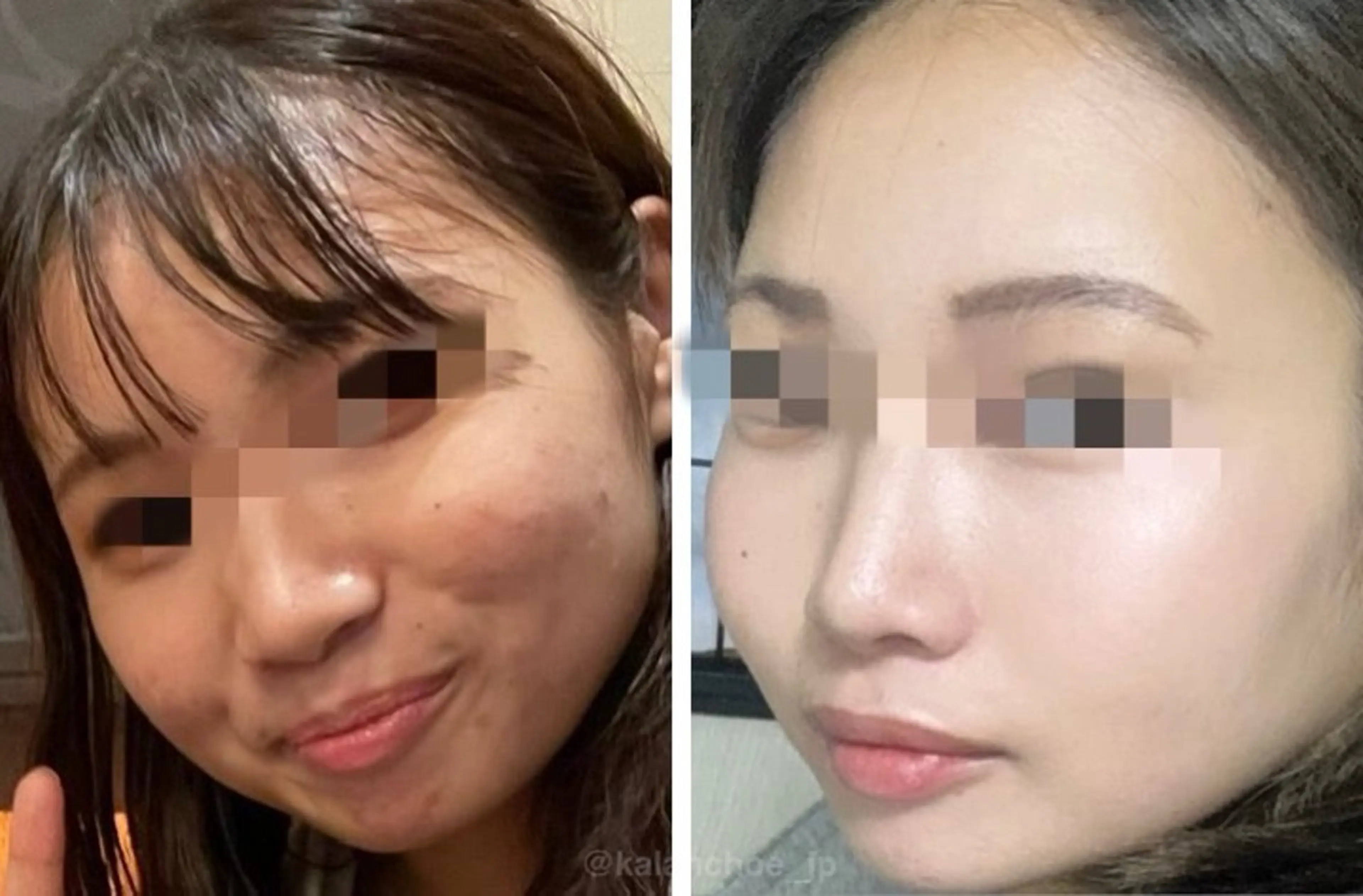 エステ 肌質改善 KALANCHOEのエステ・リラクイメージ