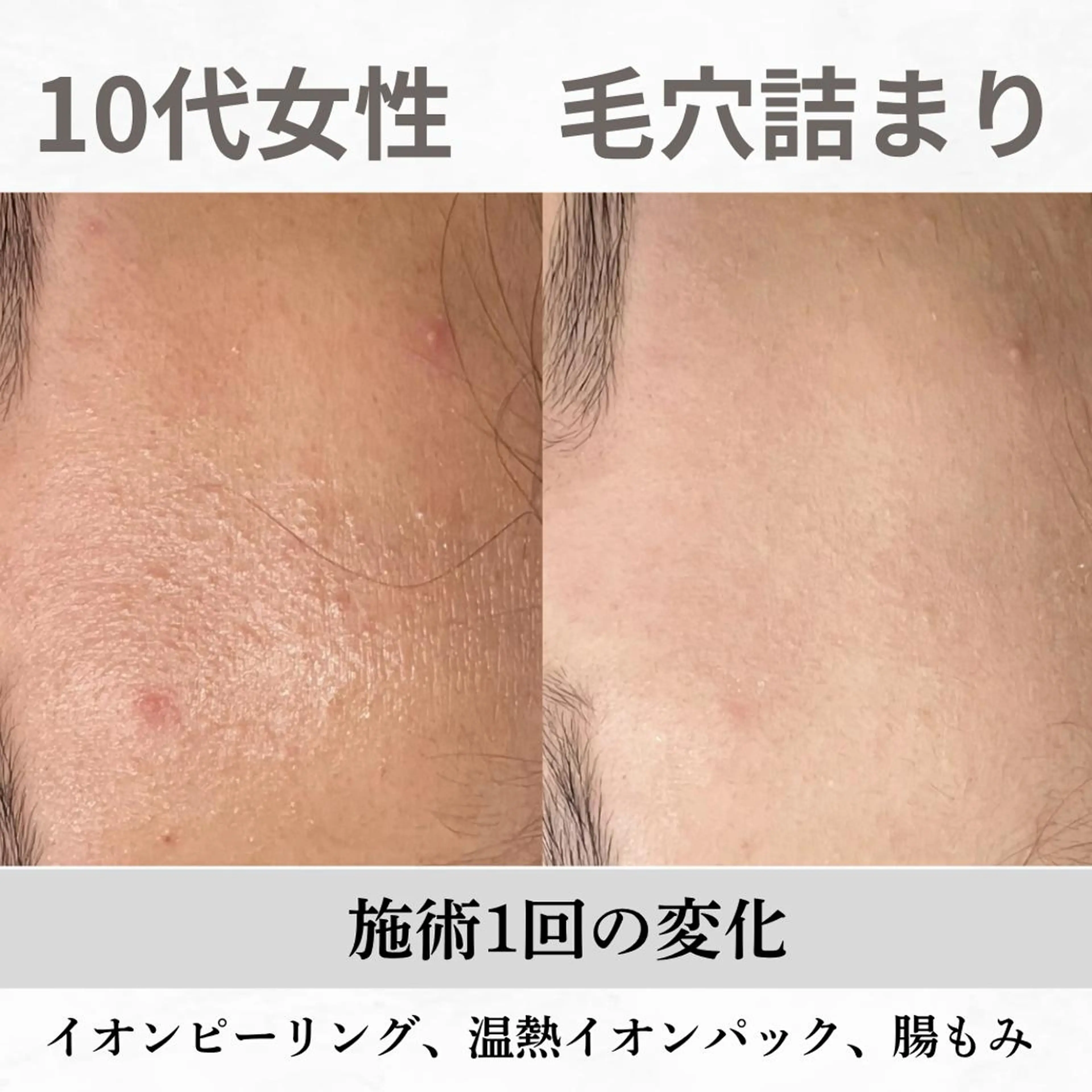 重度ニキビ専門🌷 ダウンタイムなしのエステ・リラクイメージ