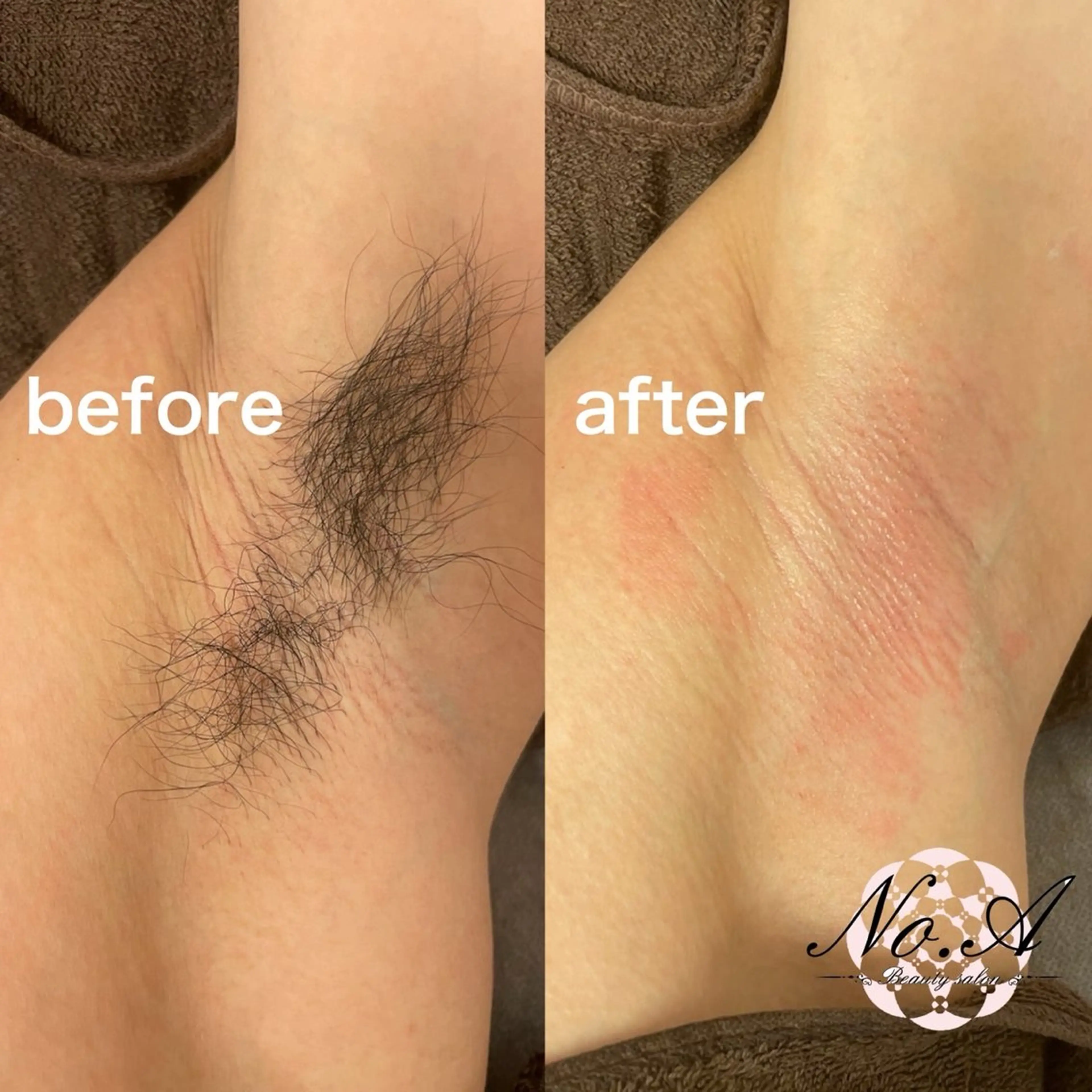 脇ダブル脱毛【女性5,000円、男性7,000円】の写真