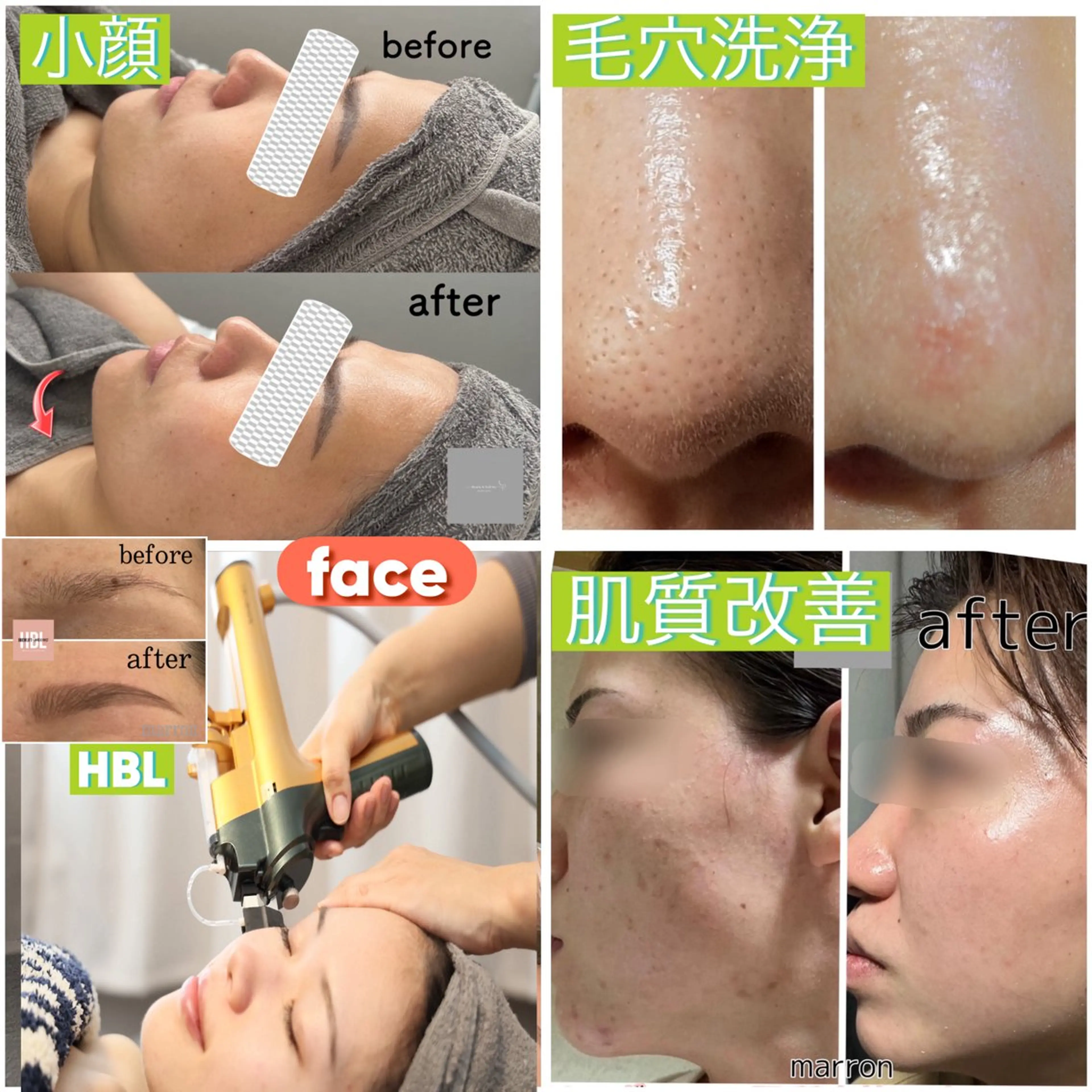 痩身ハイパーナイフ ララピールリアボーテのエステ・リラクイメージ