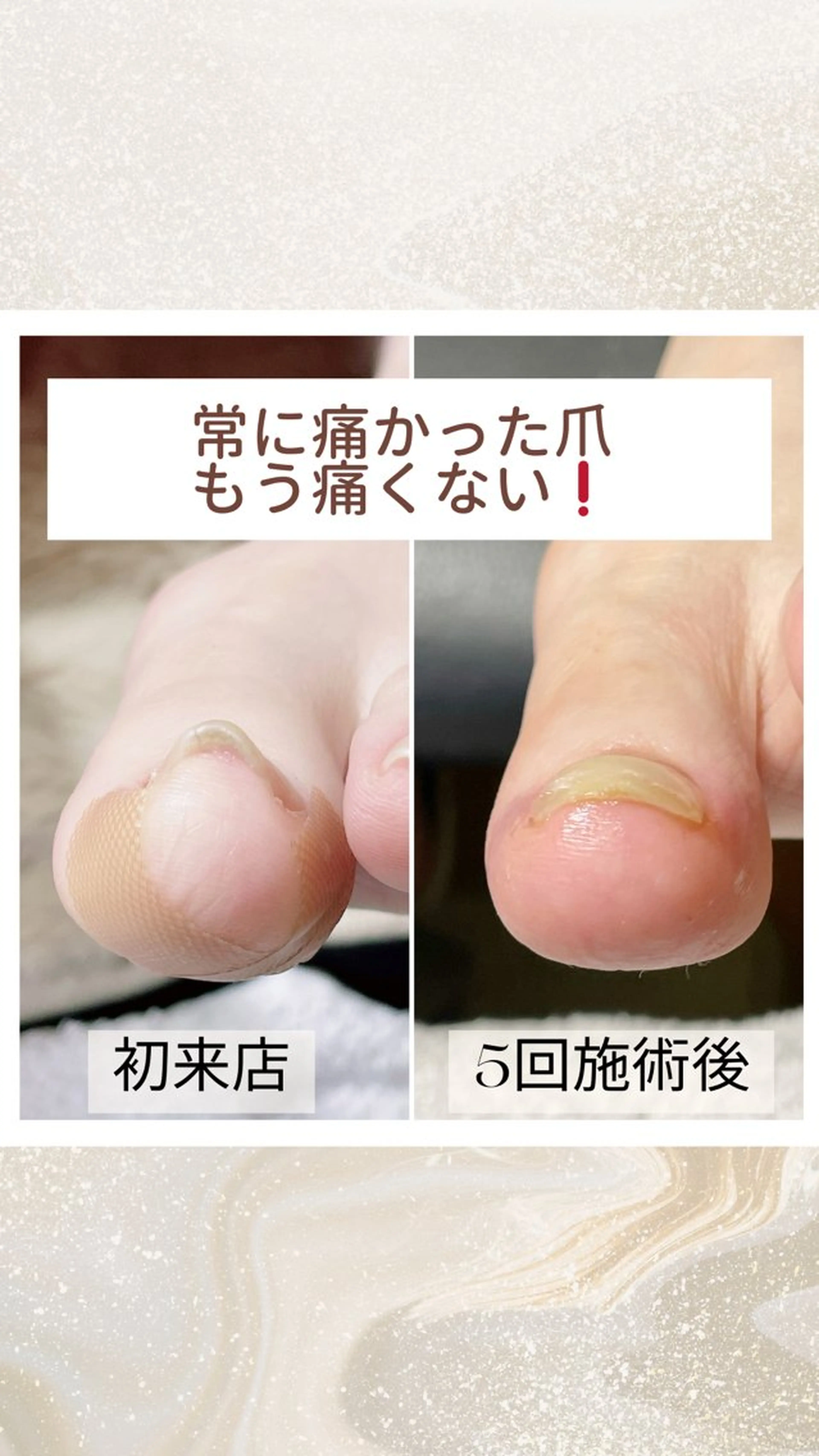 ネイル ジェルネイル 深爪・巻き爪 専門サンセリテのネイルデザイン