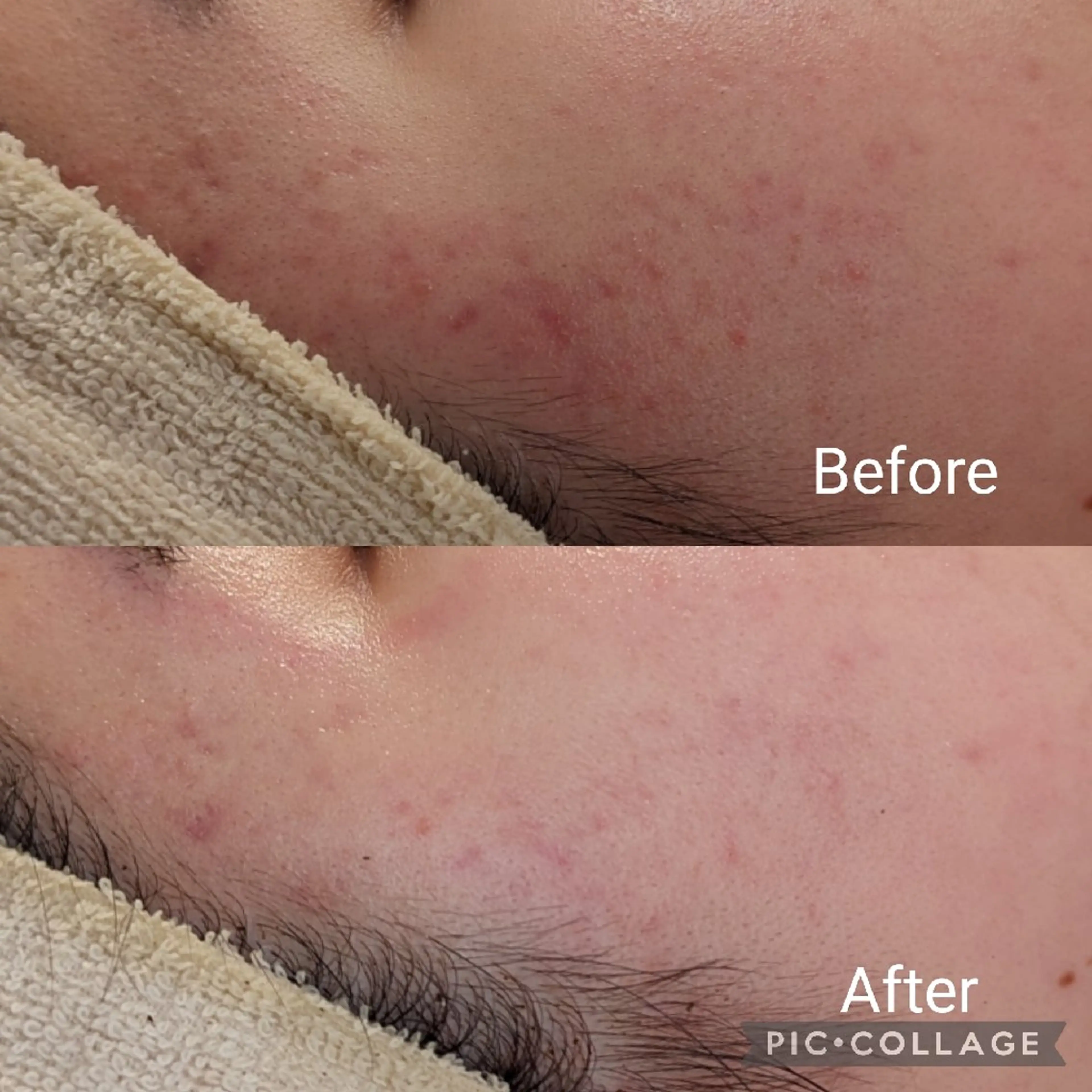 エステ 【毛穴ハーブピーリン グ】板橋1位のエステ・リラクイメージ