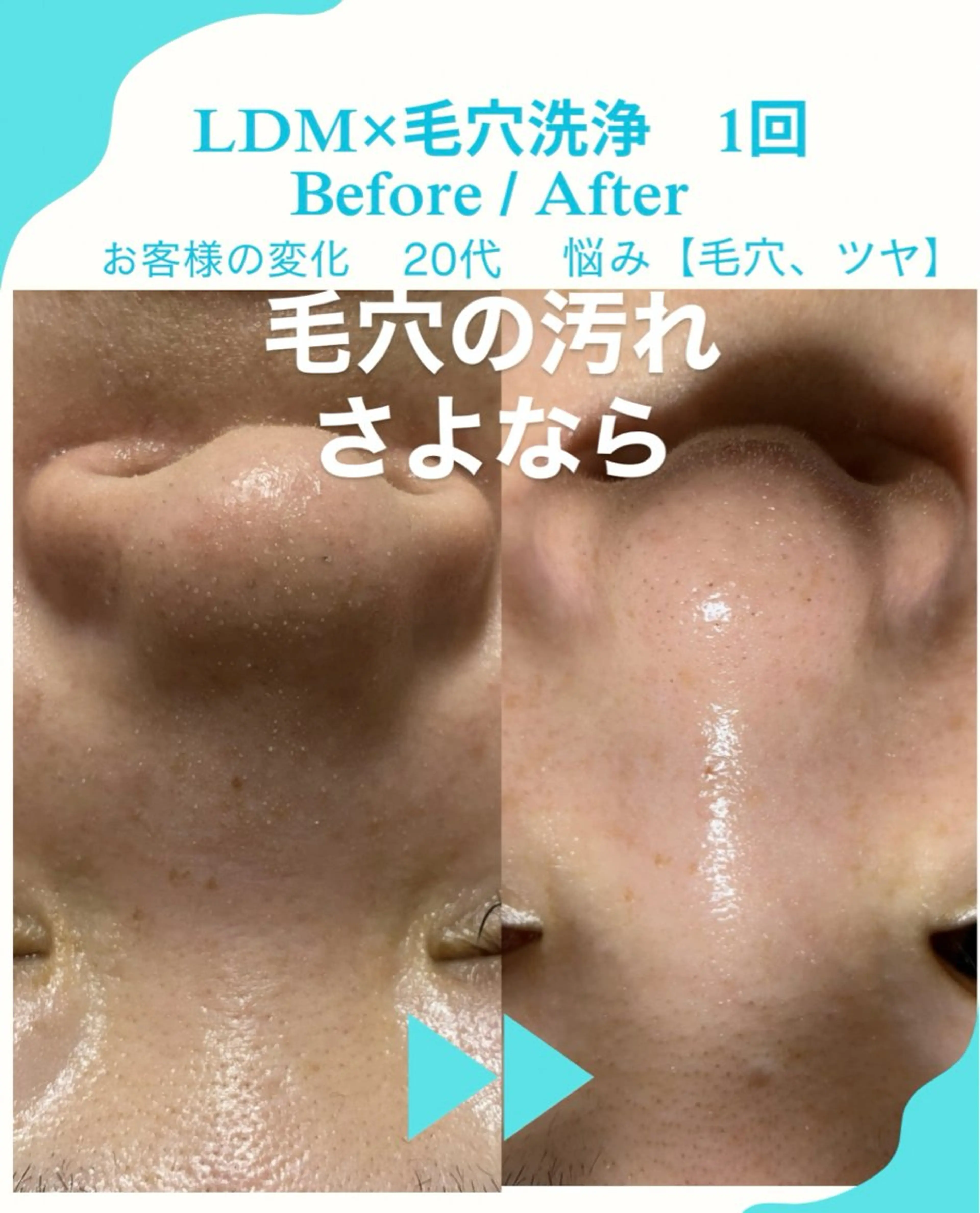 衝撃の毛穴】浮き出し→ごっそり洗浄✕美肌ケア【水光肌仕上げ】の写真