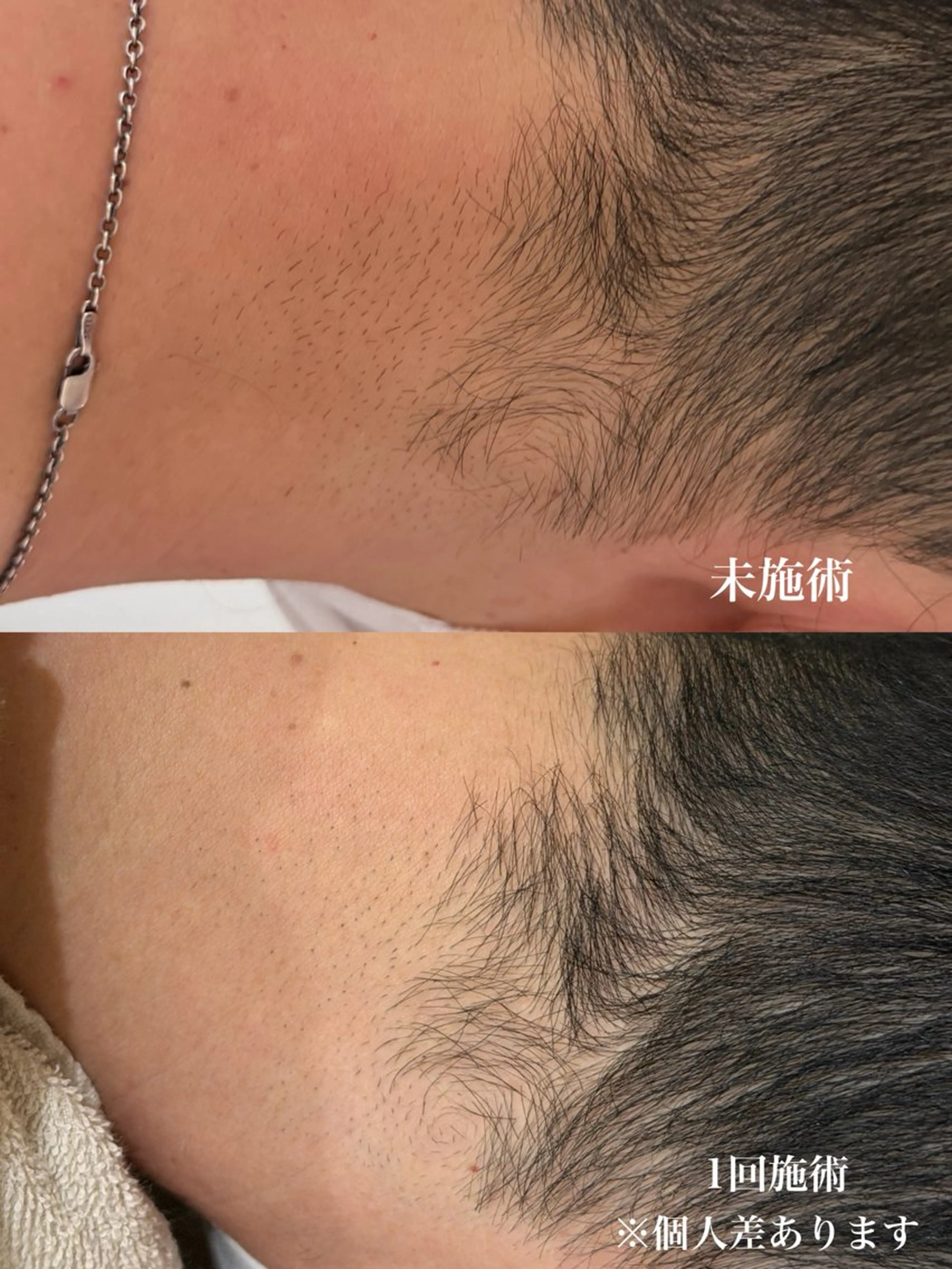 メンズうなじ脱毛の写真