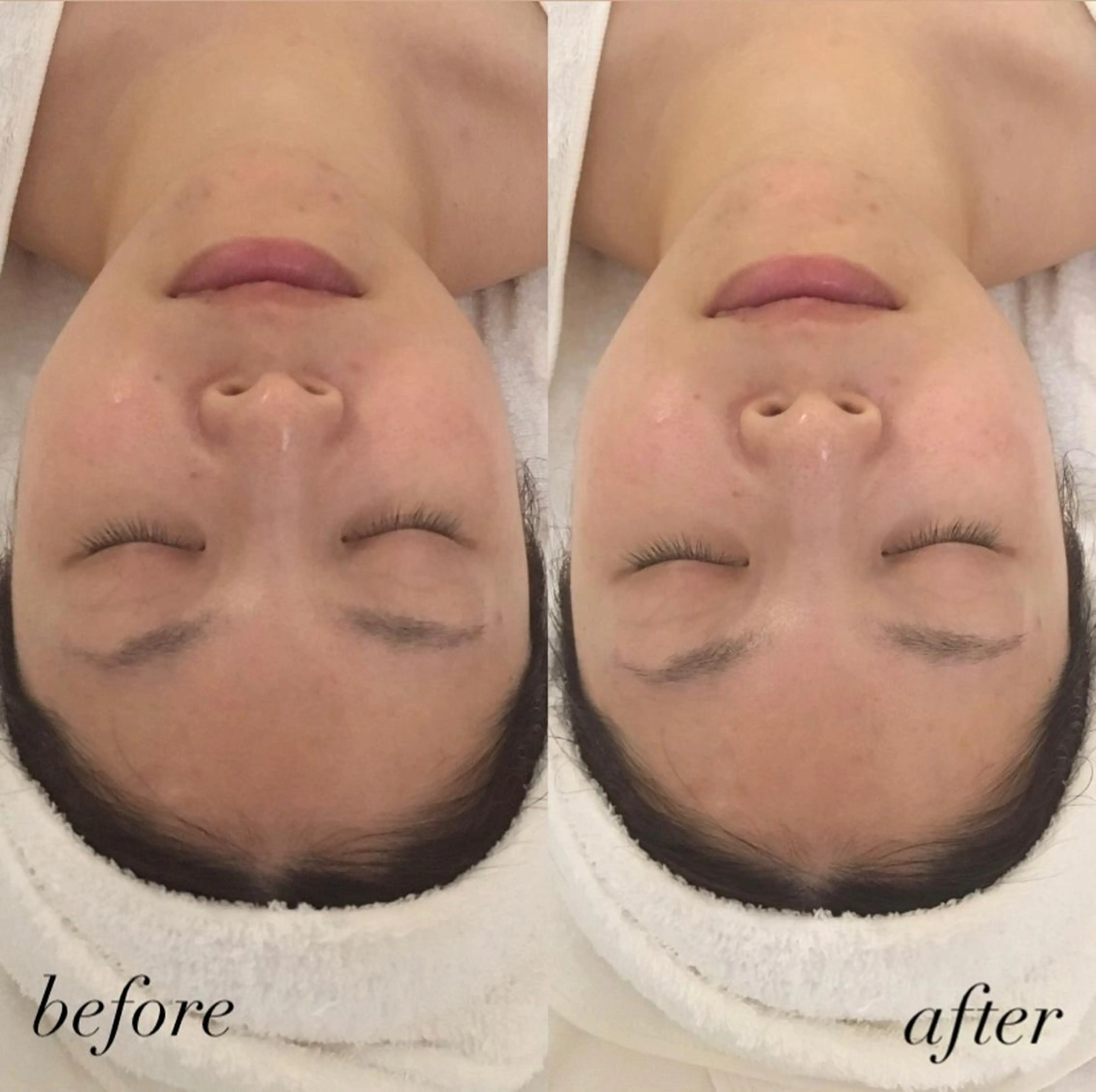 エステ リラク 韓国/ピーリング 毛穴洗浄/POLAのエステ・リラクイメージ