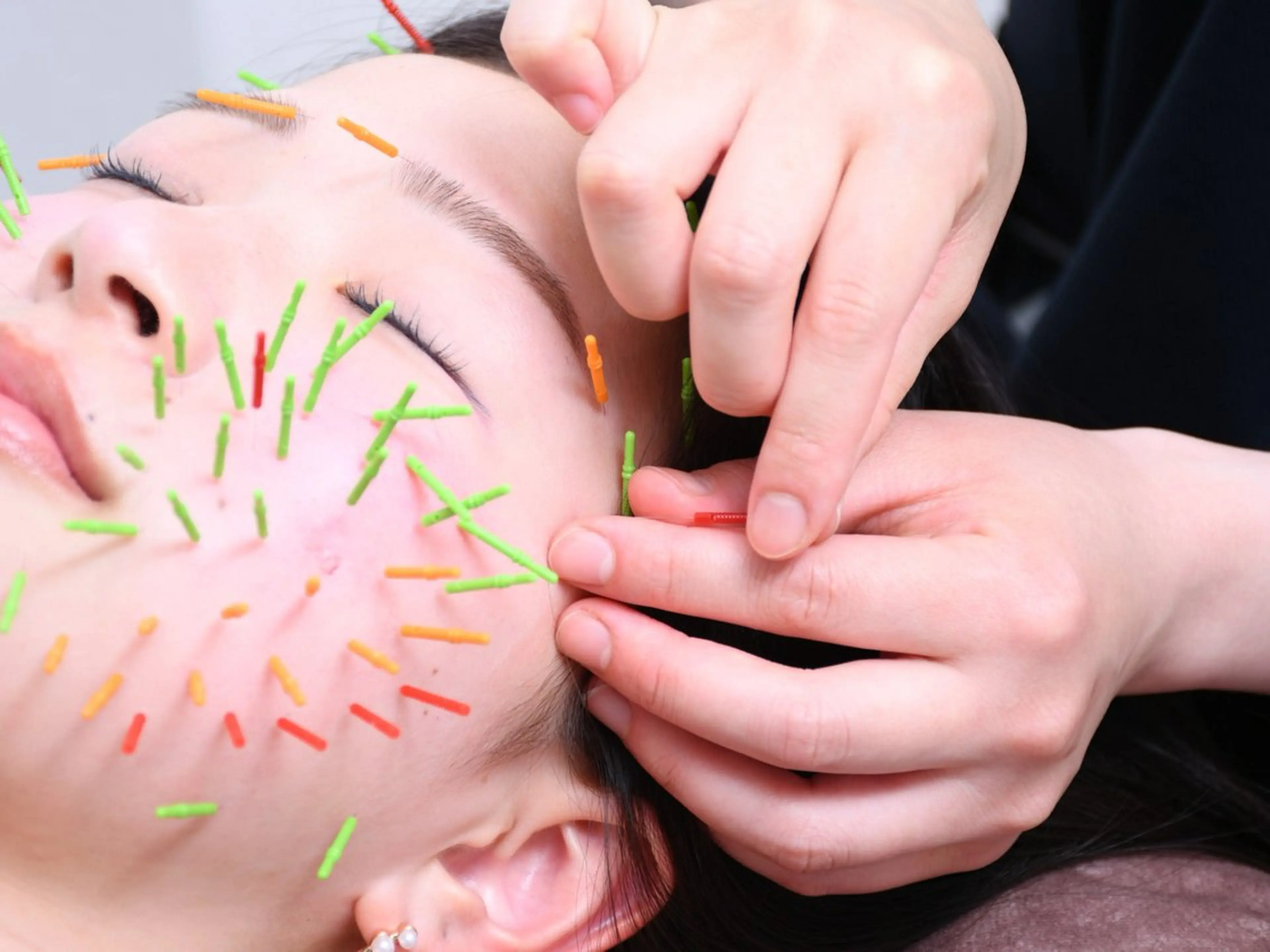 エステ リラク 美容鍼灸Solana所属・肌質改善×美容鍼 ゆいのエステ・リラクイメージ