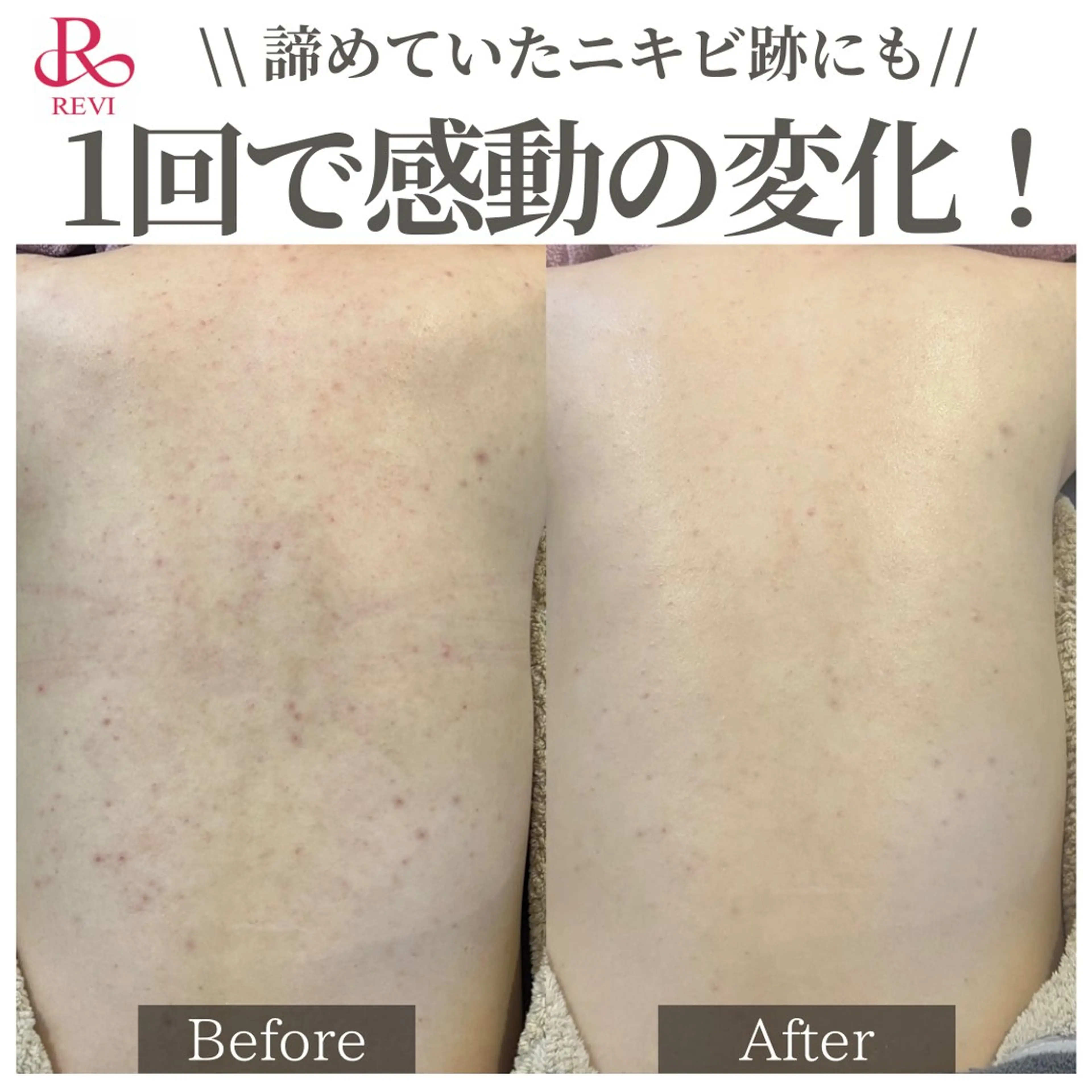 【ハーブピーリング】背中ケア★ニキビケア・肌荒れ痕に◎陶肌トリートメントの写真