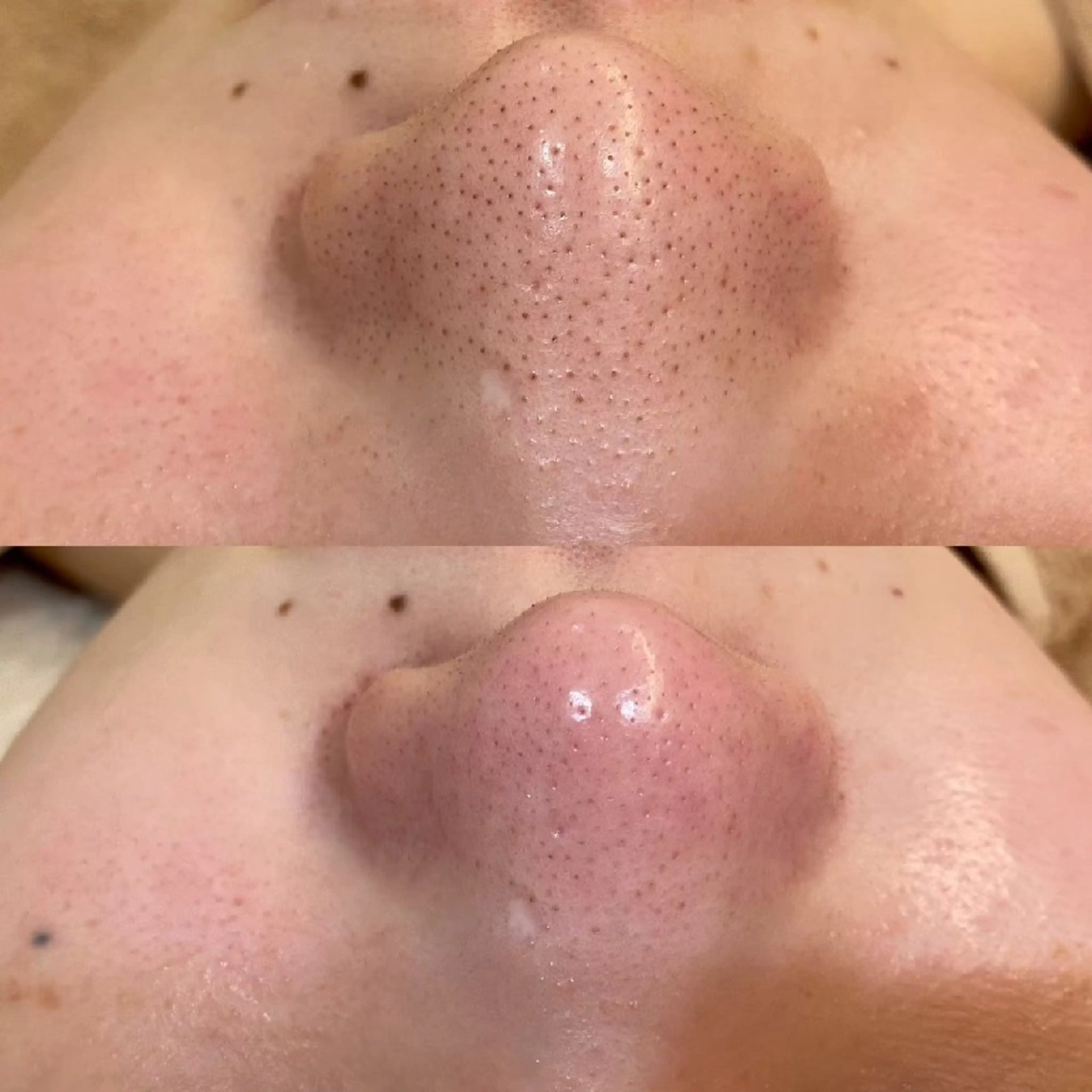 【モニター募集！】毛穴洗浄45分コース(鼻のみ)の写真