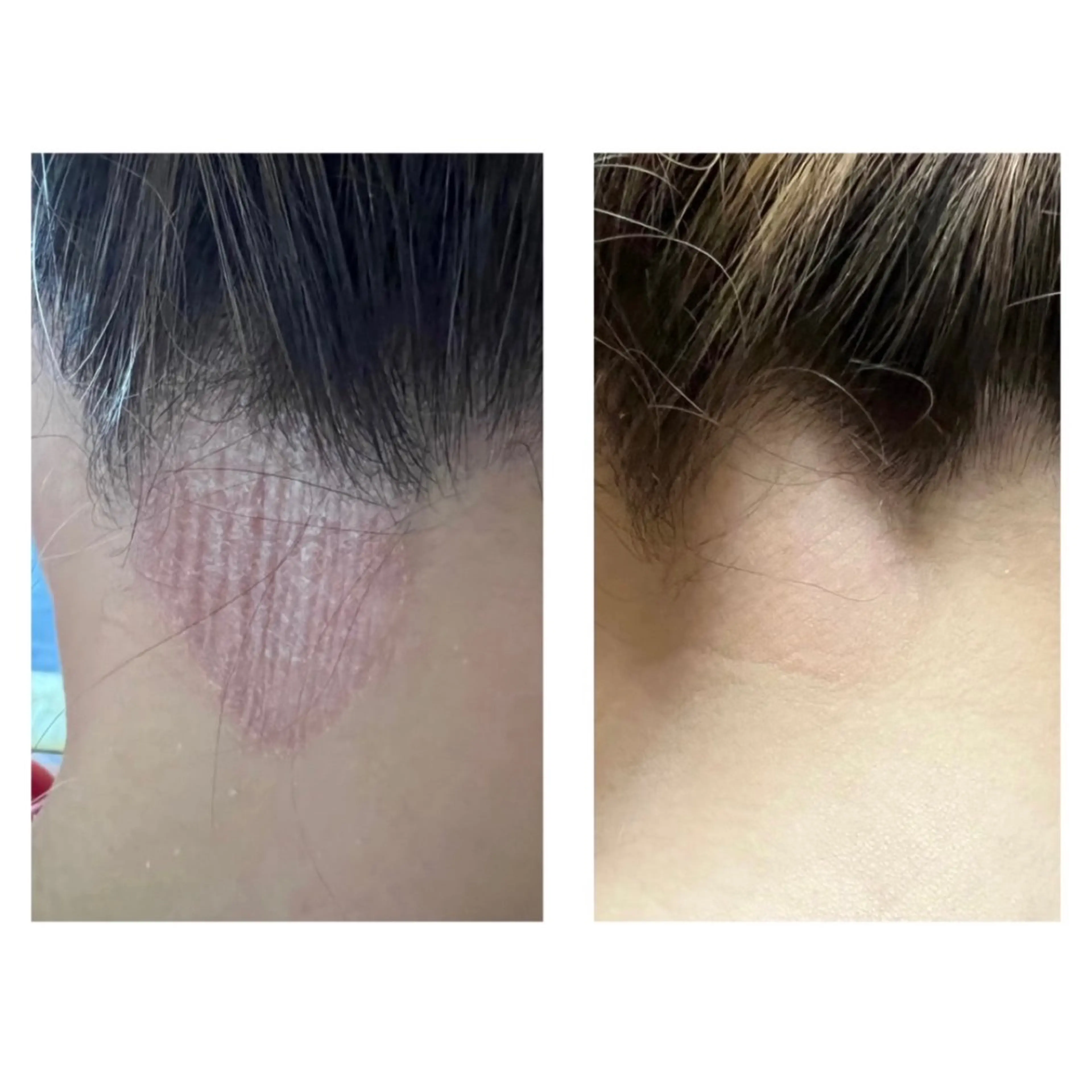 【敏感肌対応♪】肌質改善小顔リフトコース🫧 敏感肌やアトピー肌の方に対応しながら優しくリフトアップ💆🏼‍♀️✨️の写真