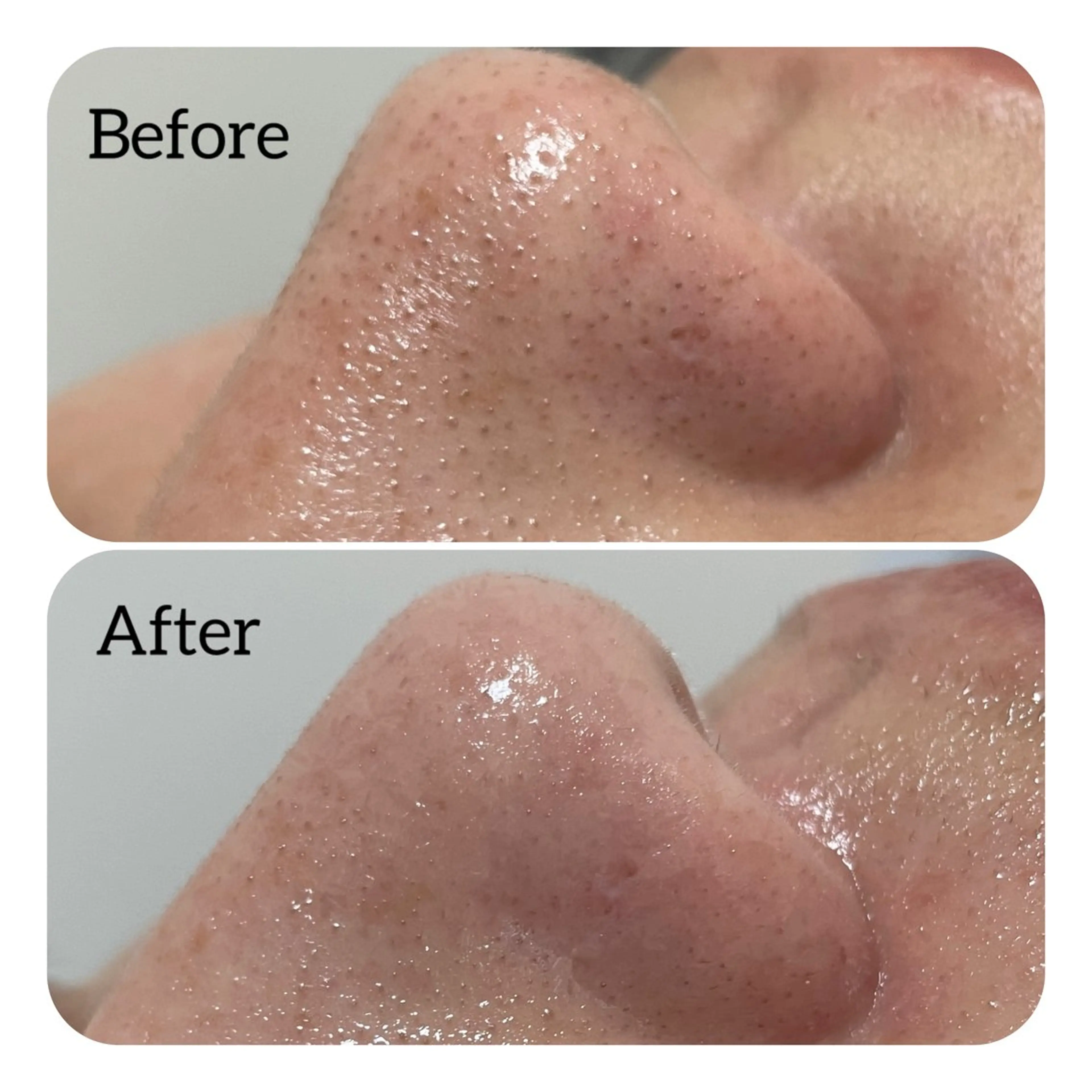 ✨ハイドラフェイシャル毛穴洗浄✨毛穴詰まり・黒ずみスッキリ✨の写真