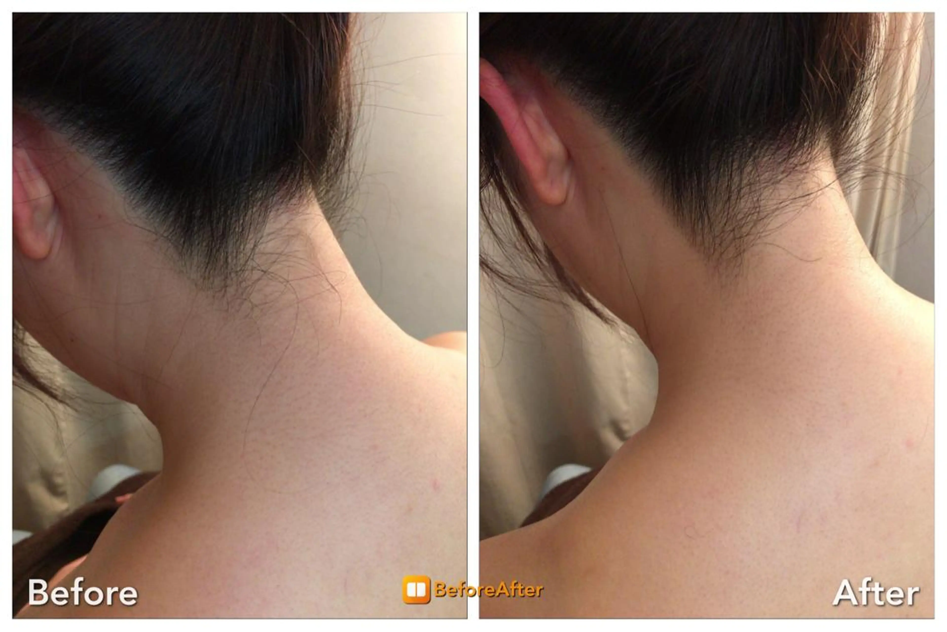 【脱毛】襟足の産毛、光脱毛で夏満喫♬(SHR、IPL、フラッシュ、光脱毛)の写真