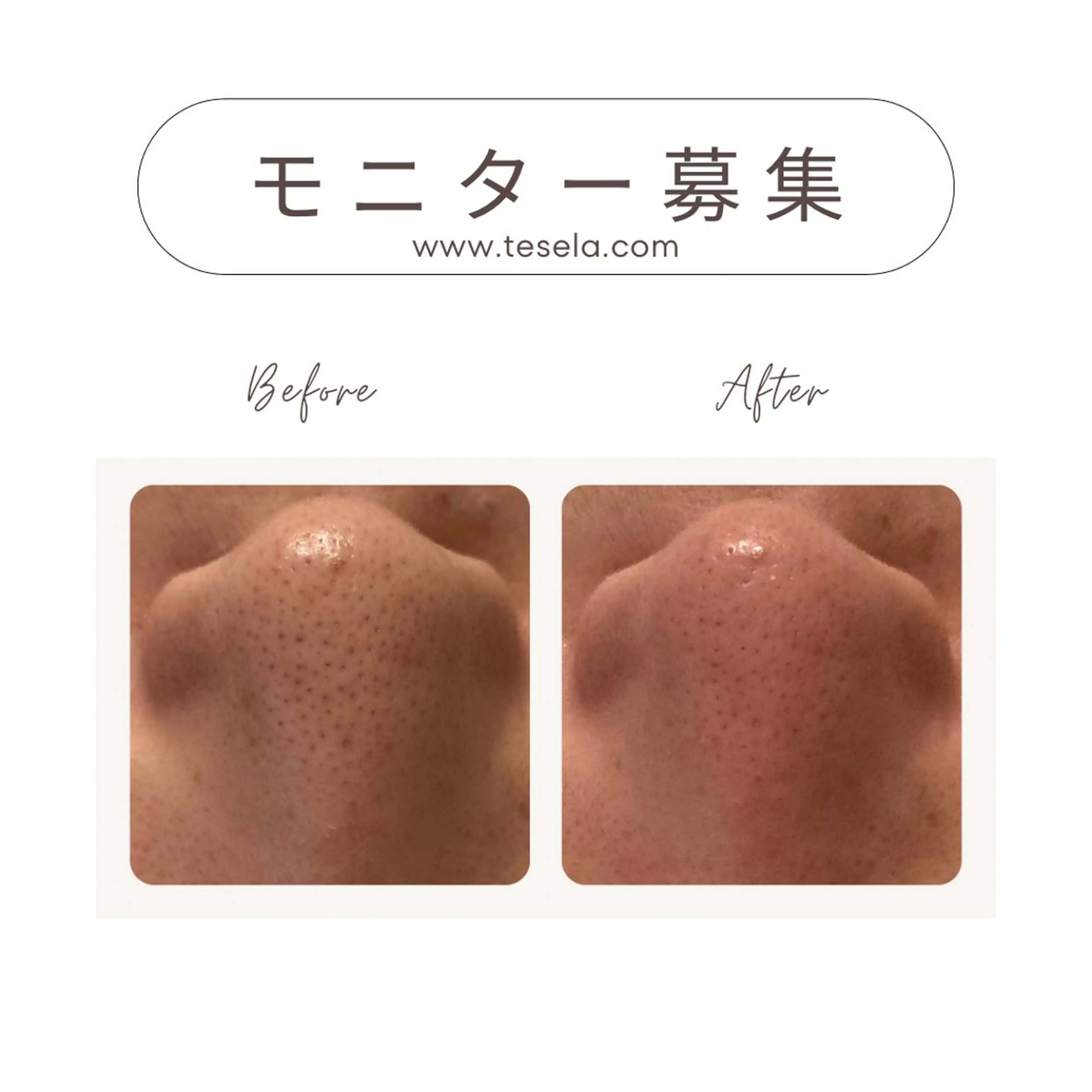 3名限定《モニター価格》水素で洗う◎毛穴洗浄/皮脂/角栓の徹底除去　ヒト幹細胞パック付き　60分　通常価格6,600円の写真