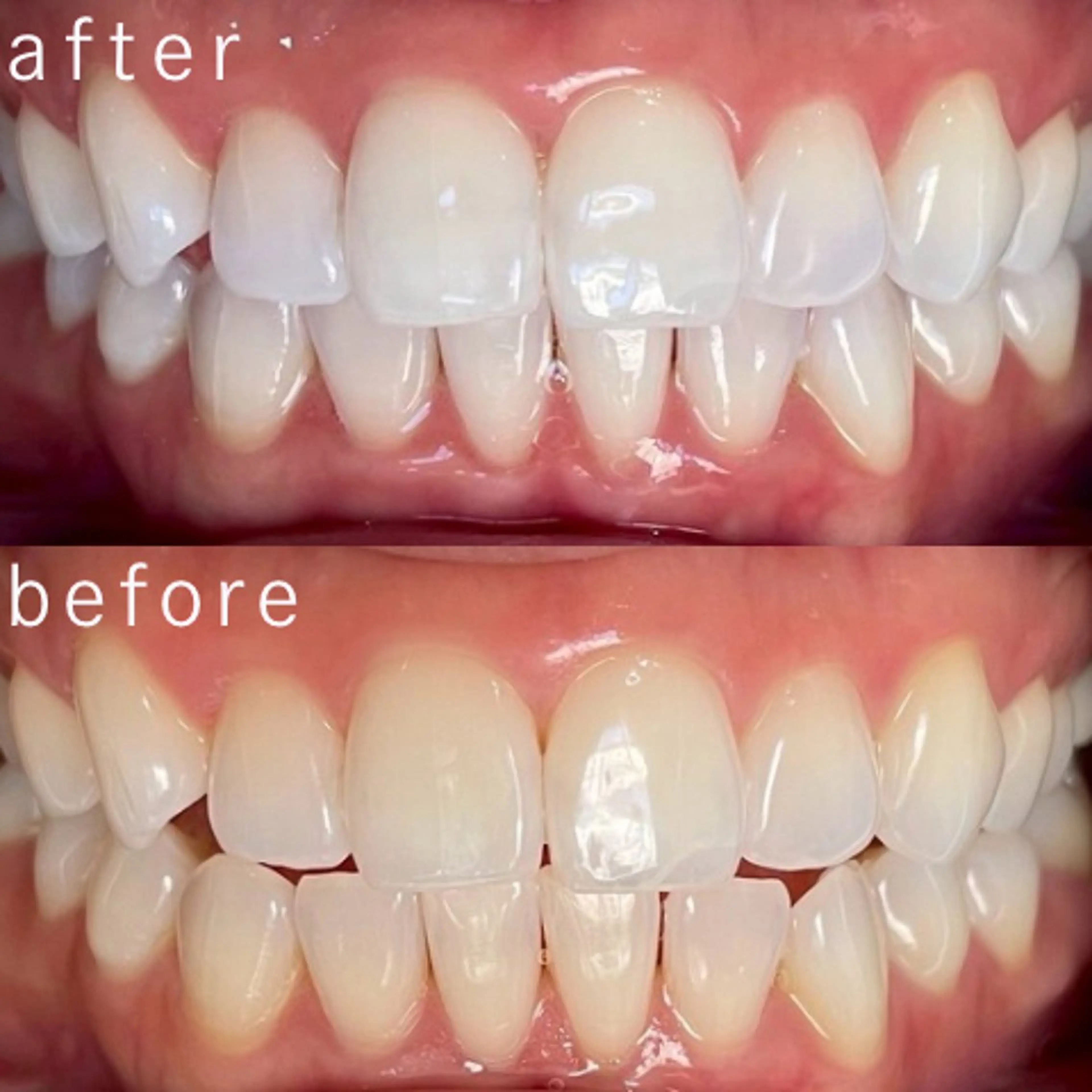 その他 セルフホワイトニング 都立大学🦷✴︎のその他イメージ