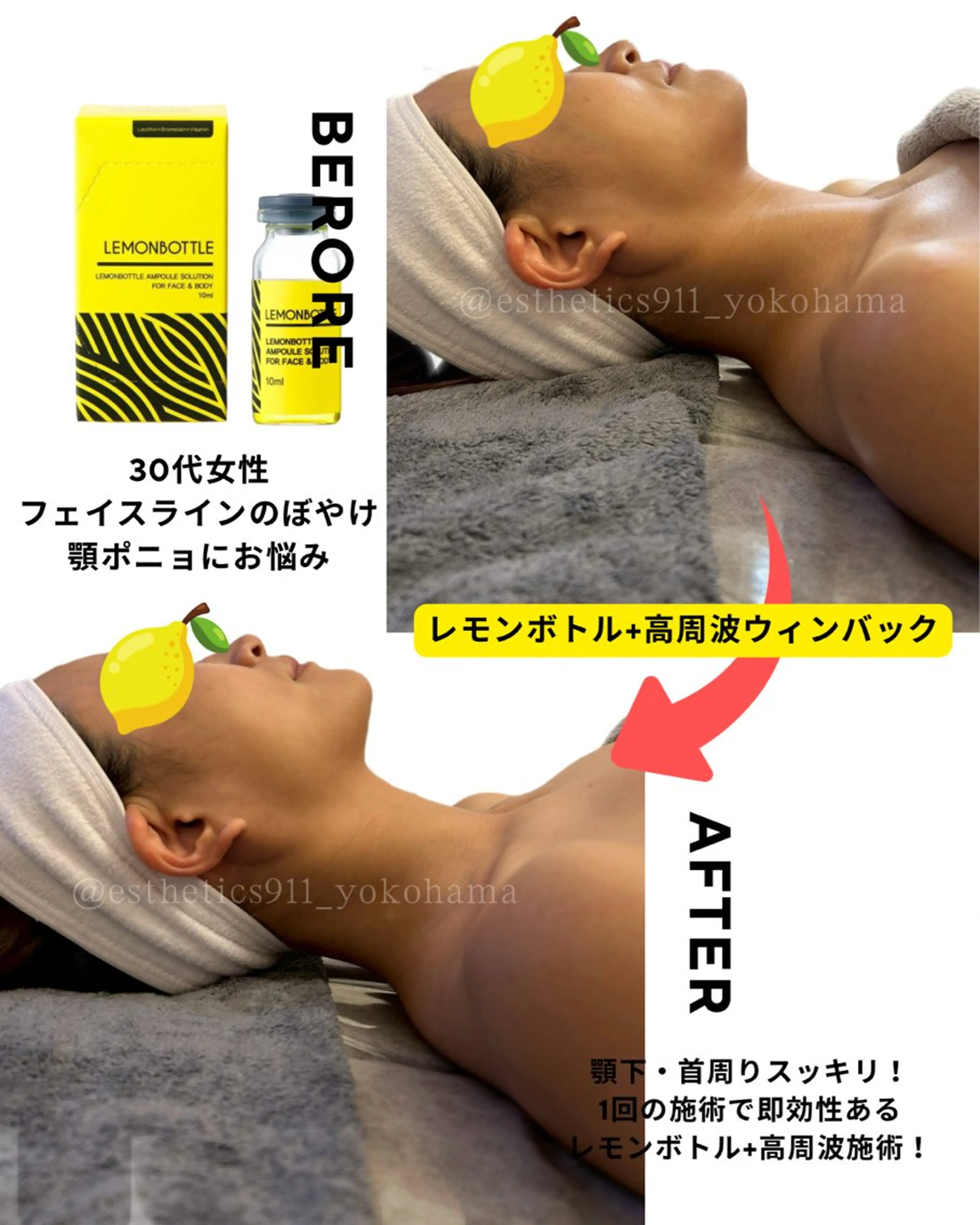 【お昼限定】肌荒れ！🍋ボトル&高周波フェイシャルエステコース初回体験の写真