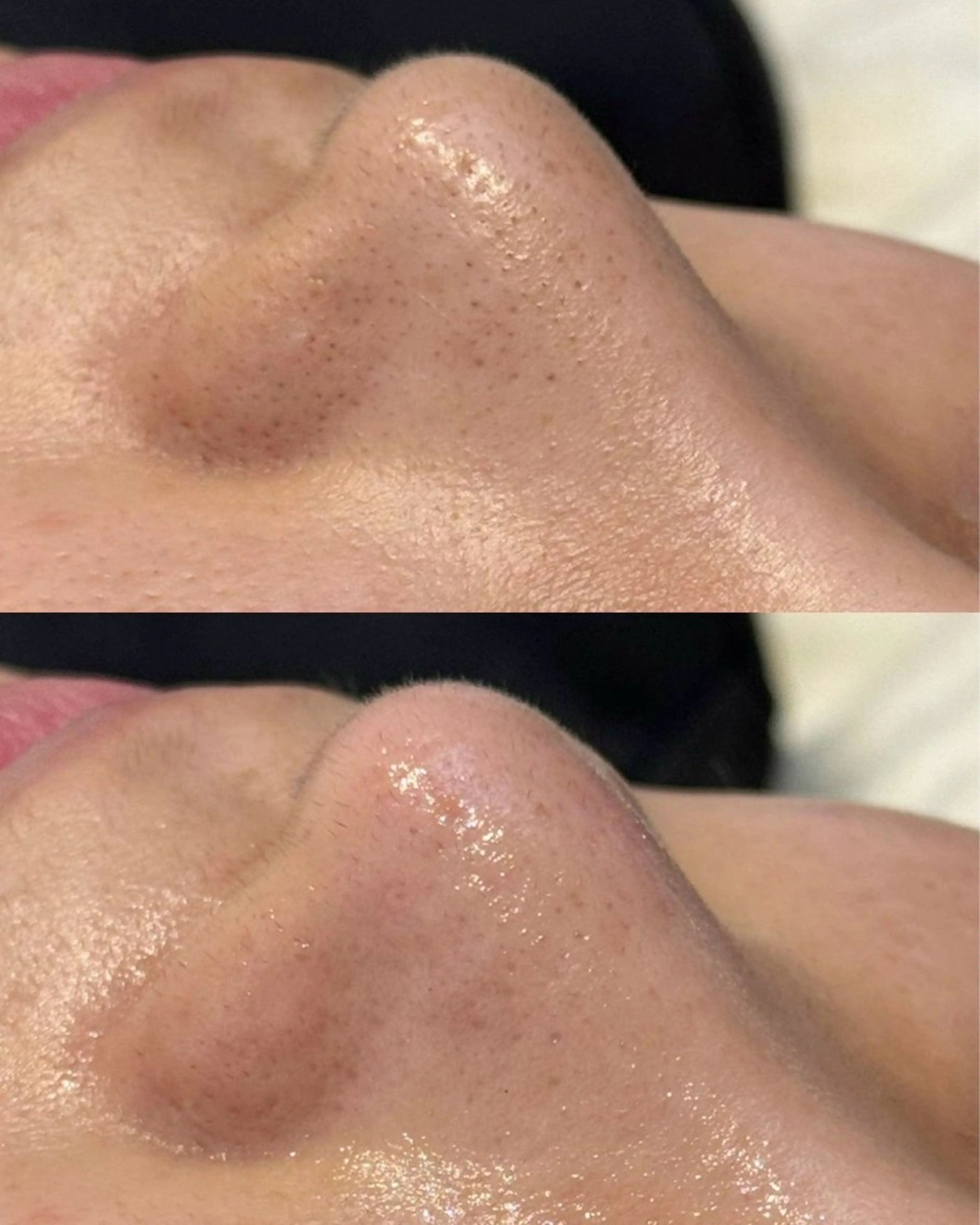 【先着5名】つるん♡毛穴スッキリmenu🫧の写真