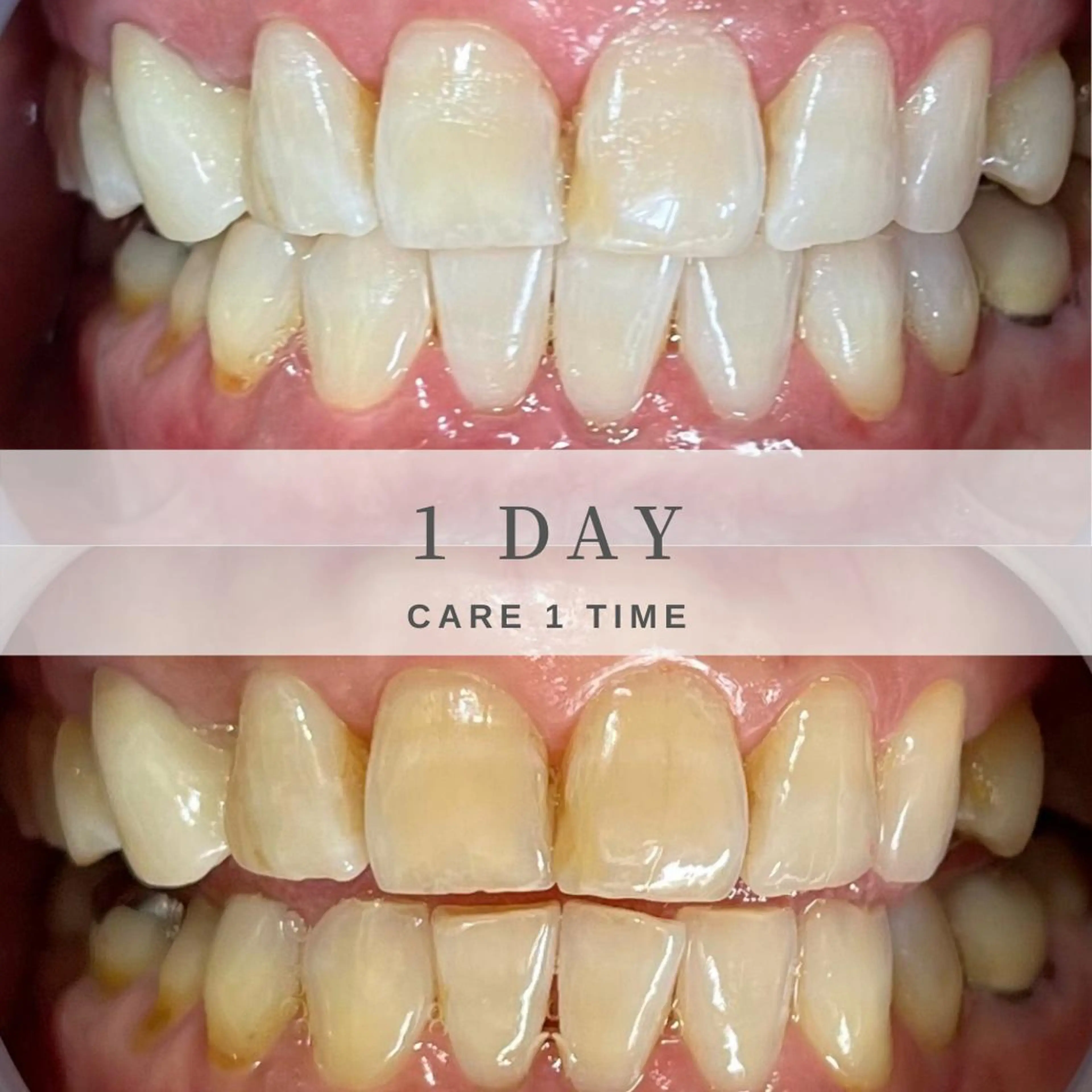 【しっかり42分照射:7min×6set】+.｡:HAHAHAお試し価格ﾟ+:｡.の写真