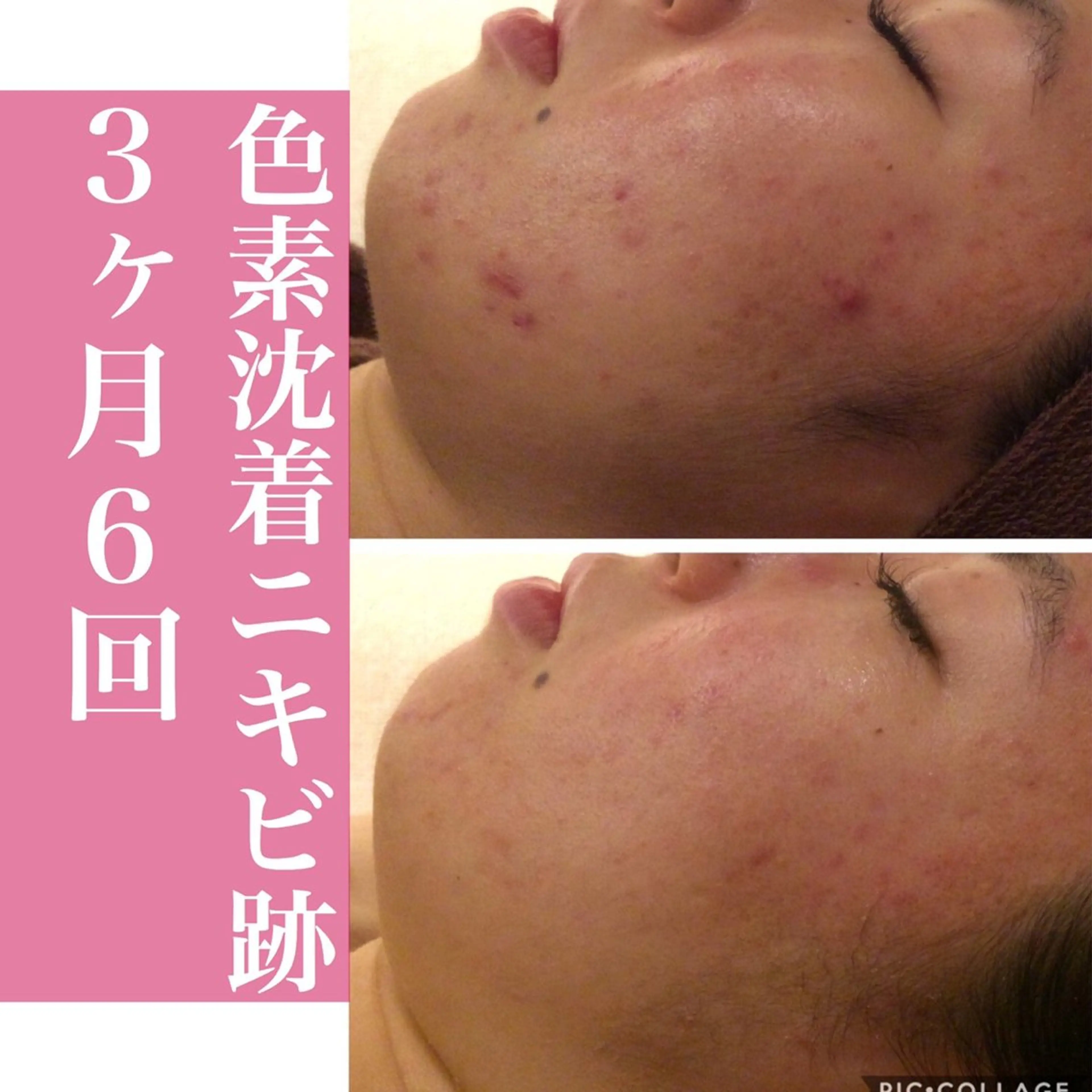 エステ リラク ニキビ・肌質改善専門 ♡人生が変わるサロンのエステ・リラクイメージ