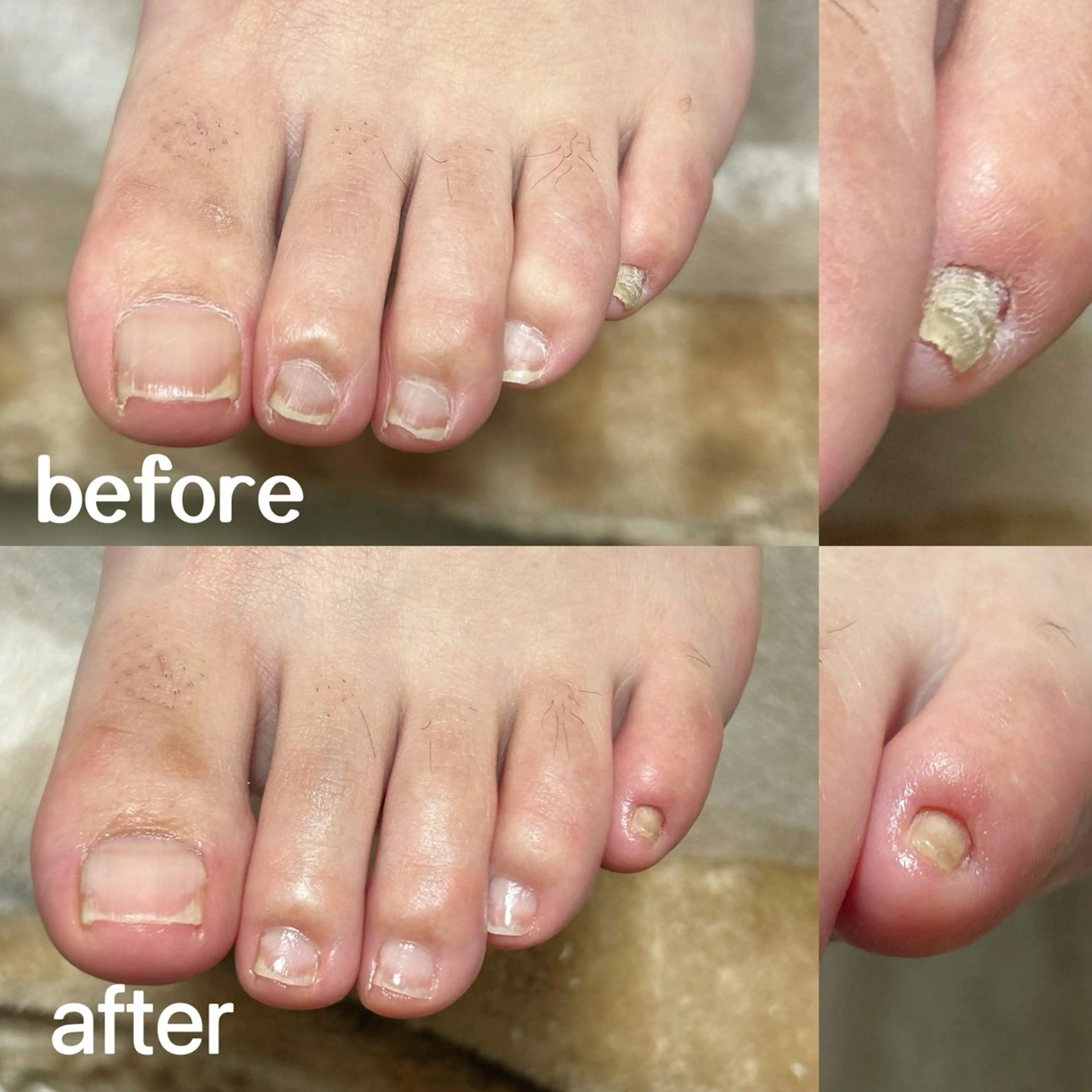 足の爪切りケアの写真