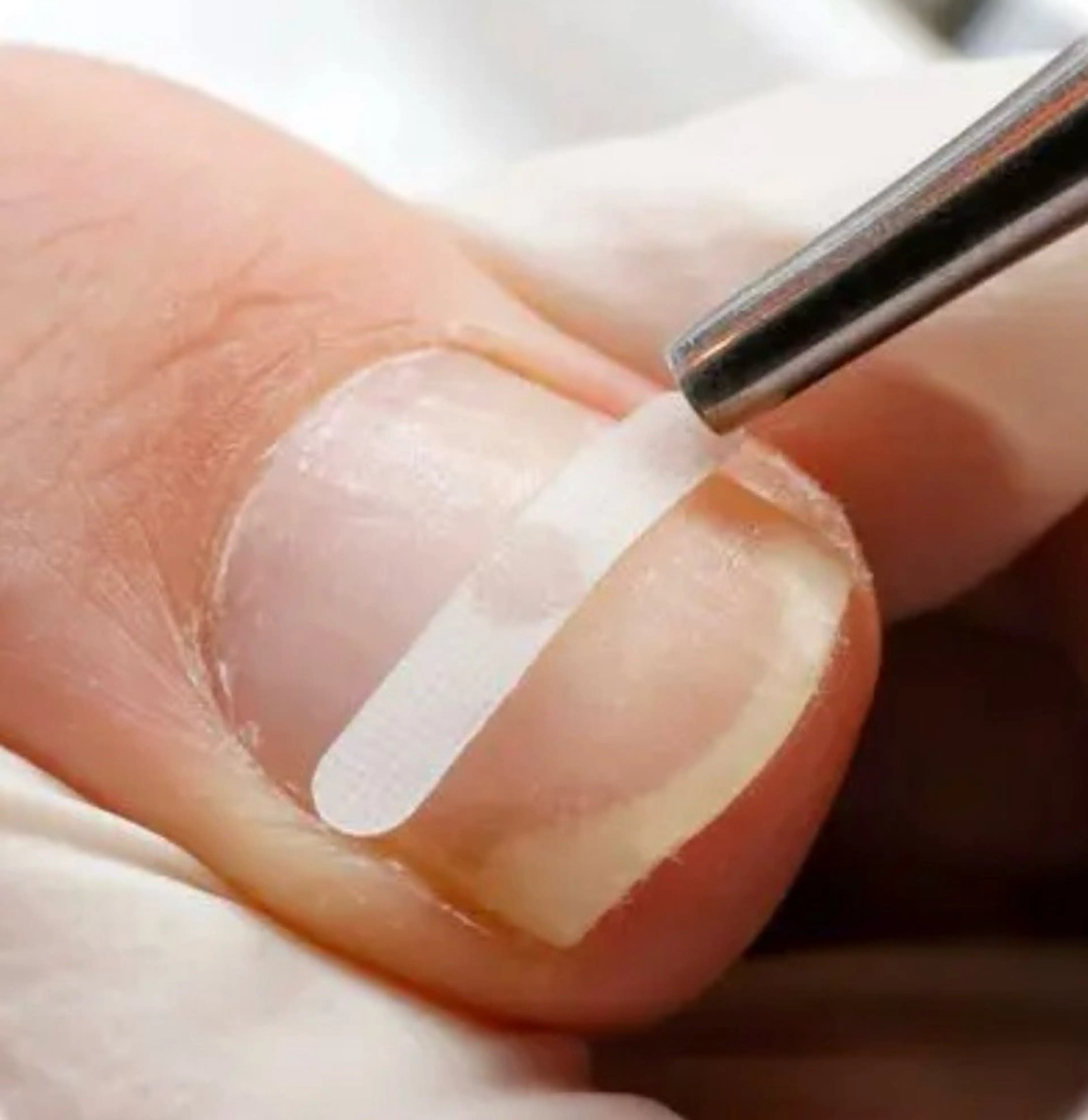 【急募！】巻き爪補正👣1本5500円→2200円✨の写真