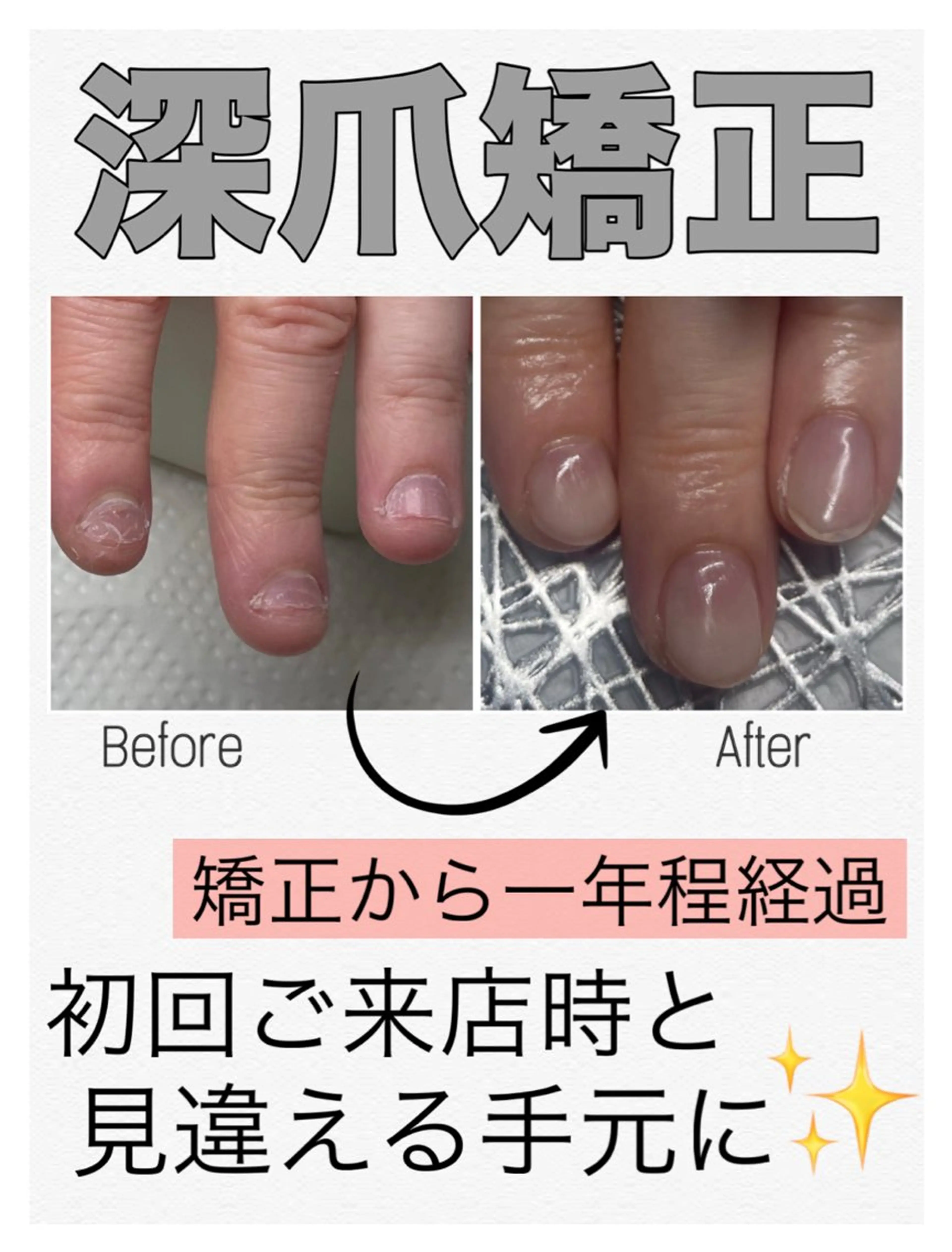 平日限定❤️‍🔥深爪矯正【長さ出し】◆カラーなし◆むしったり割れたり噛んで小さくなってしまった爪も美しく綺麗な状態にの写真