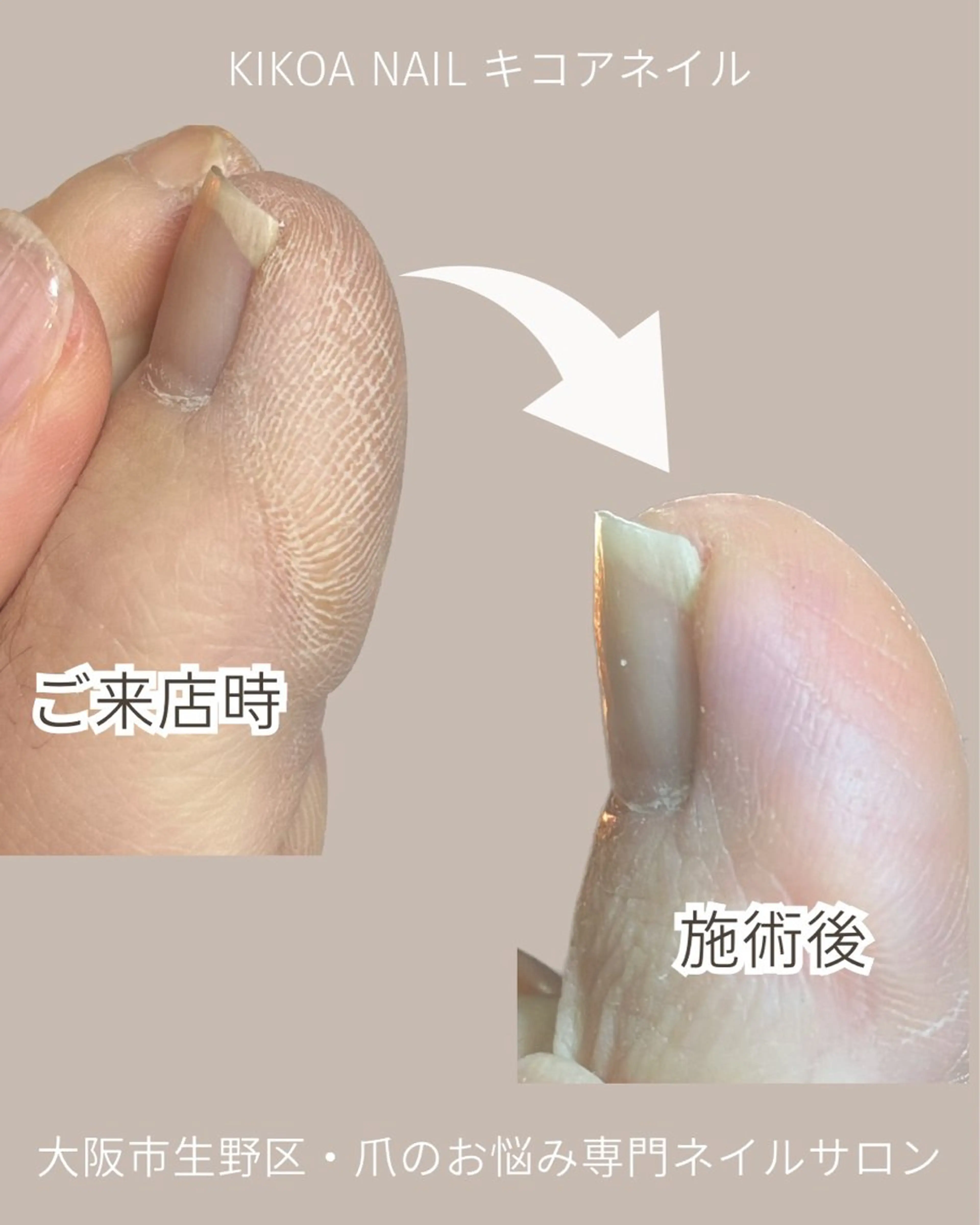 ネイル フットネイル フットネイル KIKOA NAIL キコアネイルのネイルデザイン