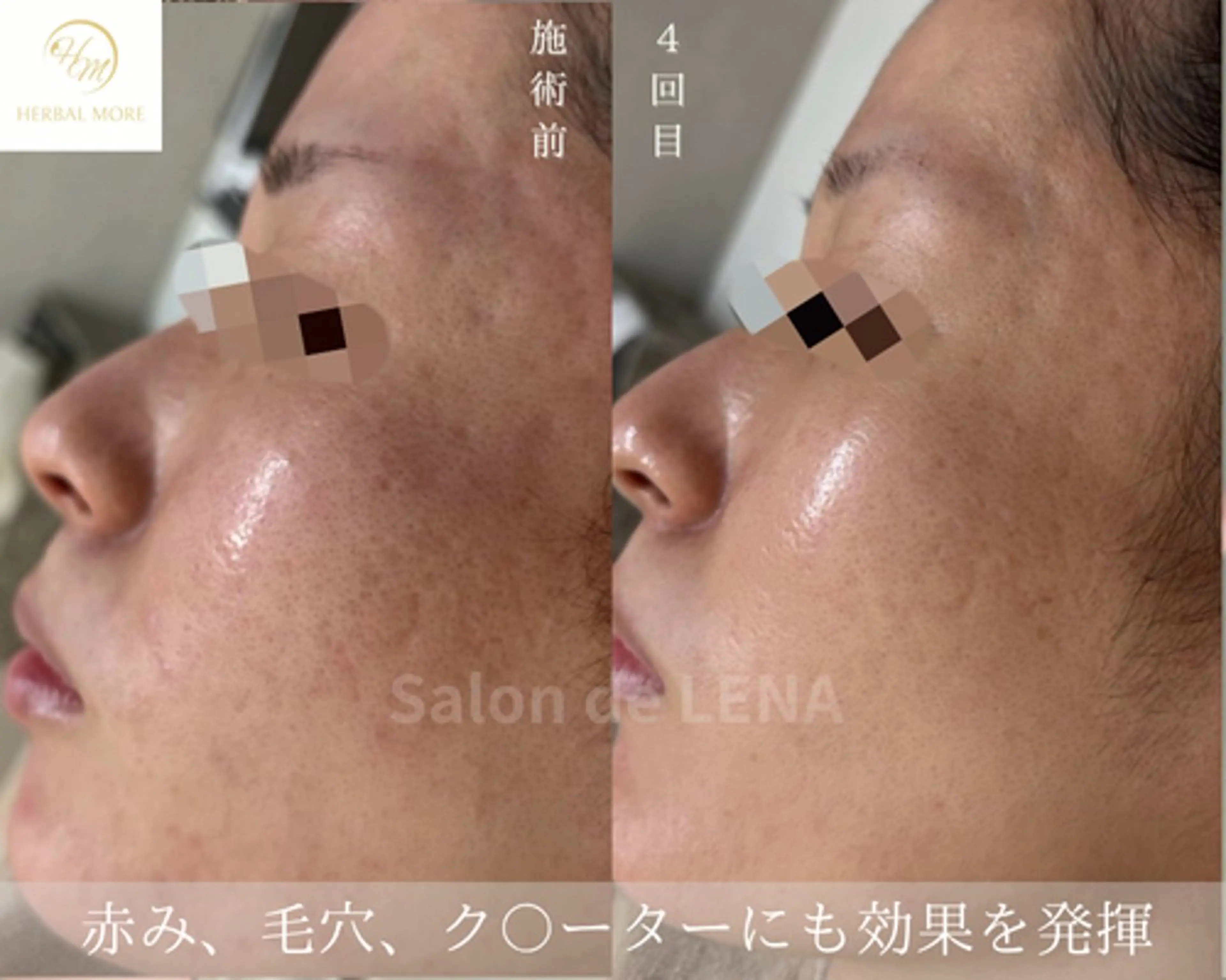 ハーブピーリング・毛穴ケア専門サロンSalon de LENA 栄店所属・ハーブピーリング専門 サロンドレナ　白藤のエステ・リラクイメージ