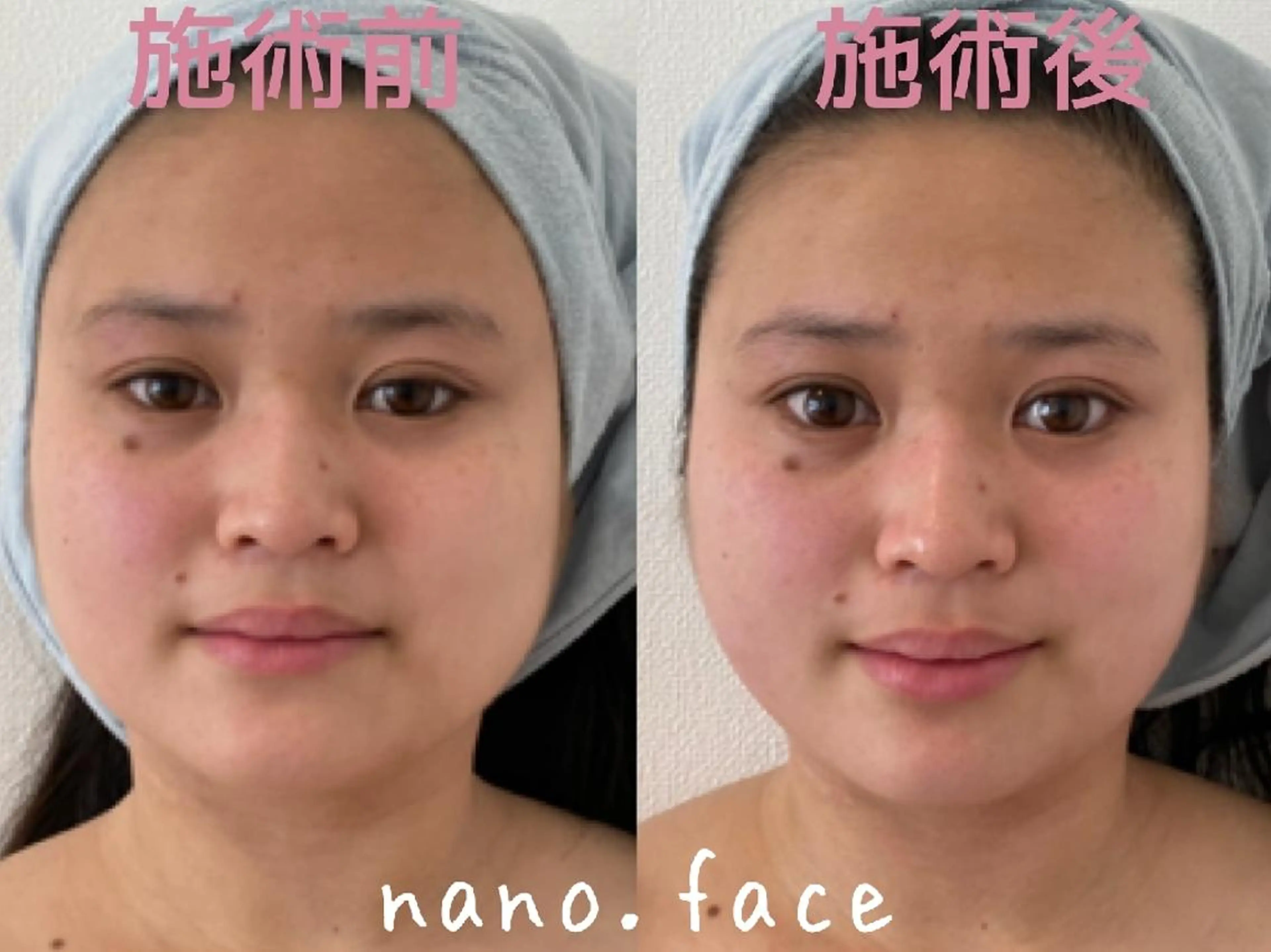 マツエク・マツパ 美容鍼/小顔&整体 nano.faceのエステ・リラクイメージ