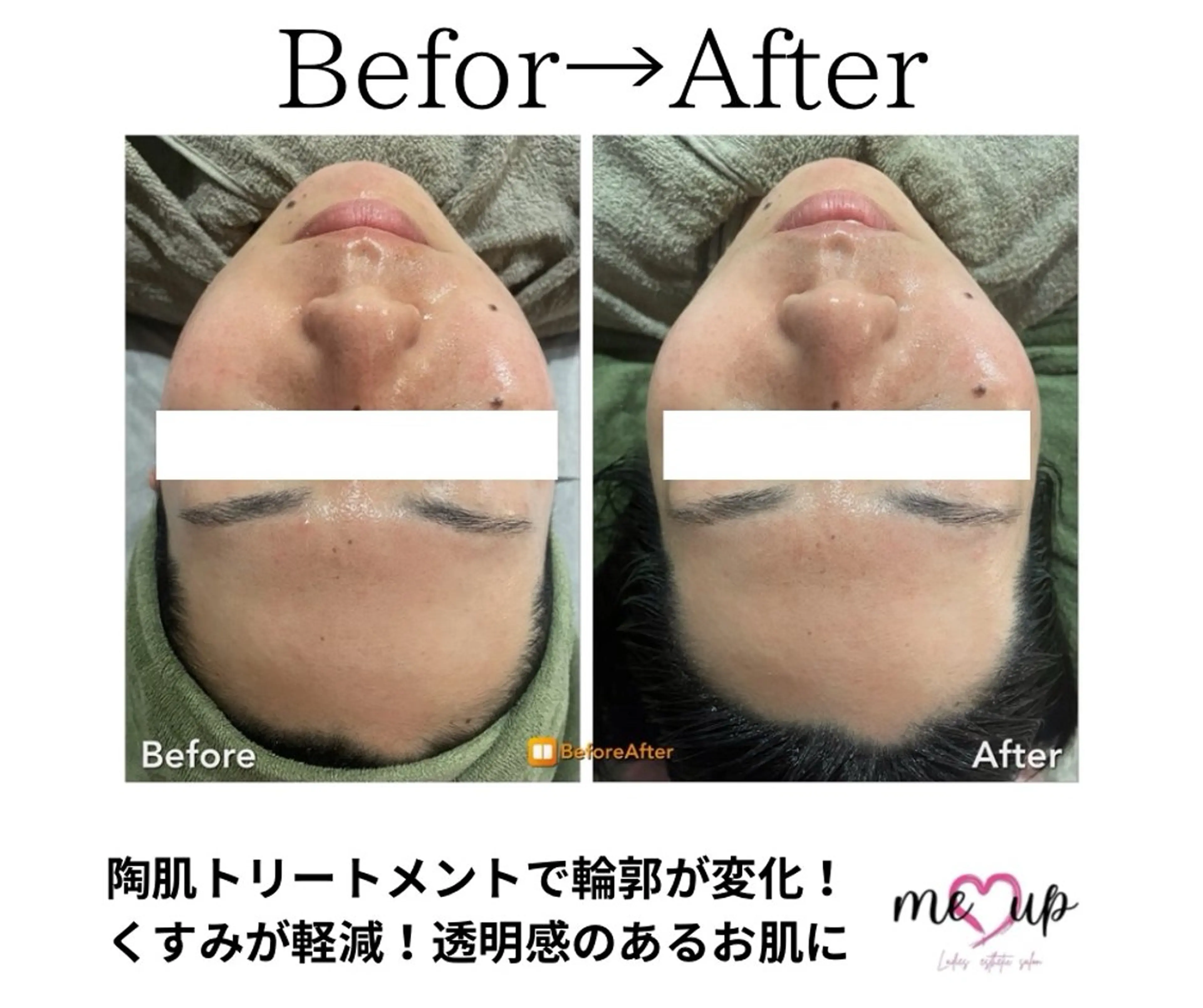 エステ Meupニキビ専門店 背中/ハーブ/肌管理のその他イメージ