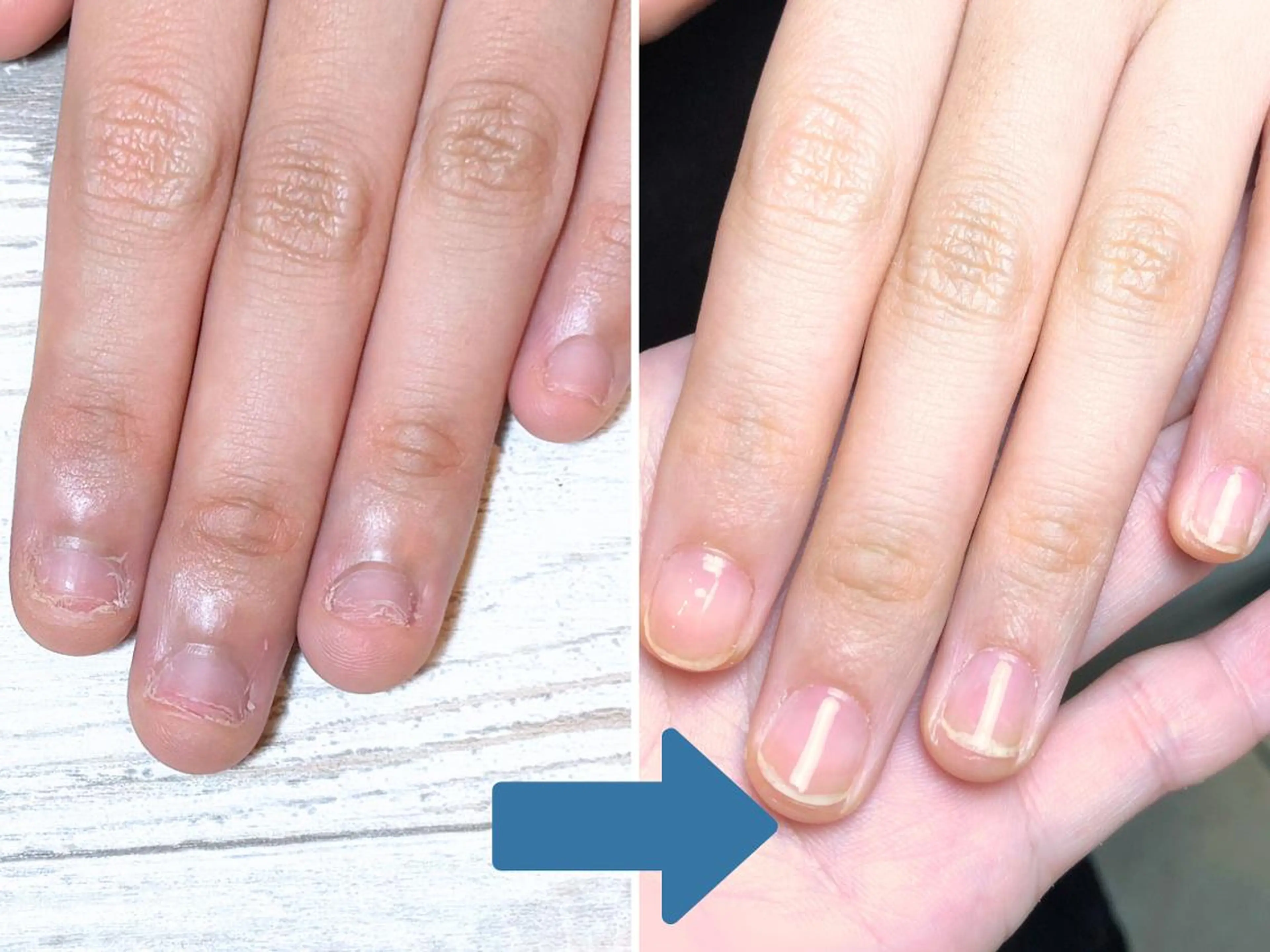 ネイル 深爪矯正・自爪育成 ネイルサロンアモまいのネイルデザイン